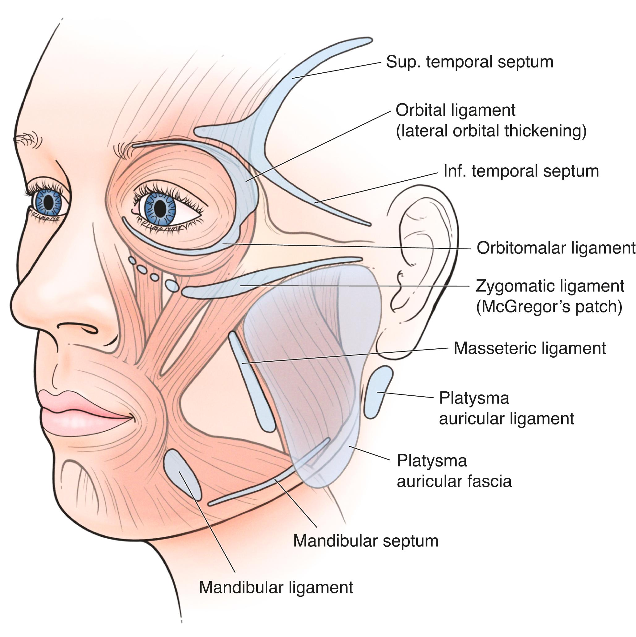 Figure 7.5, The osseocutaneous retaining ligaments. In the midface: orbitomalar osseocutaneous, or orbital ligaments (near the frontozygomatic suture suspending the eyebrow), and zygomatic osseocutaneous ligaments (McGregor’s patch at the junction of zygoma and arch). In the lower face: the masseteric cutaneous ligament and mandibular ligaments. The soft tissues are tightly secured over the parotid gland by the platysma auricular fascia and ligament.