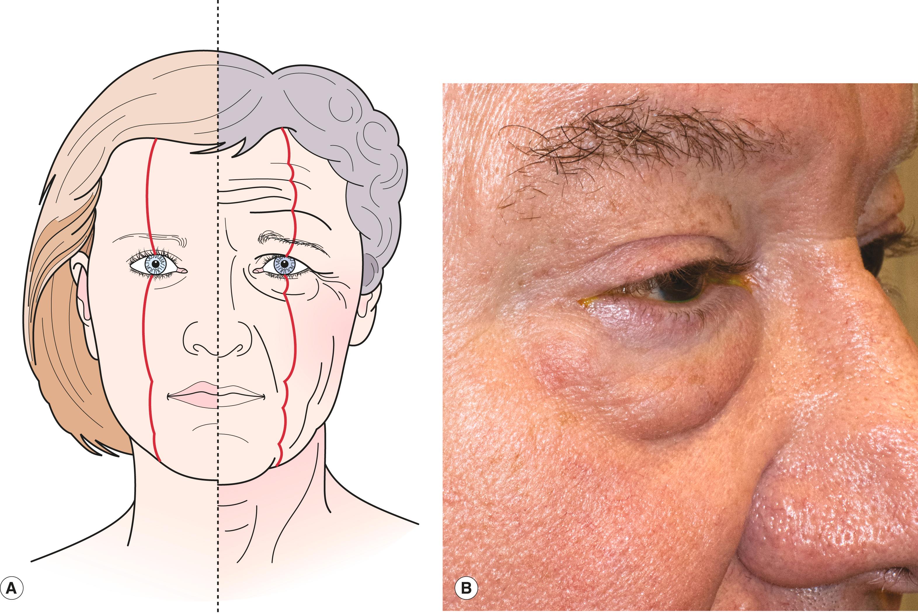 Figure 7.7, The double convexity and hills and valleys of the aging face. ( A ) A predictable series of convexities form in the aging face. ( B ) As the cheek descends and the eyelid fat prolapses forward, the normal smooth contour of the lower eyelid is lost and the double convexity forms.