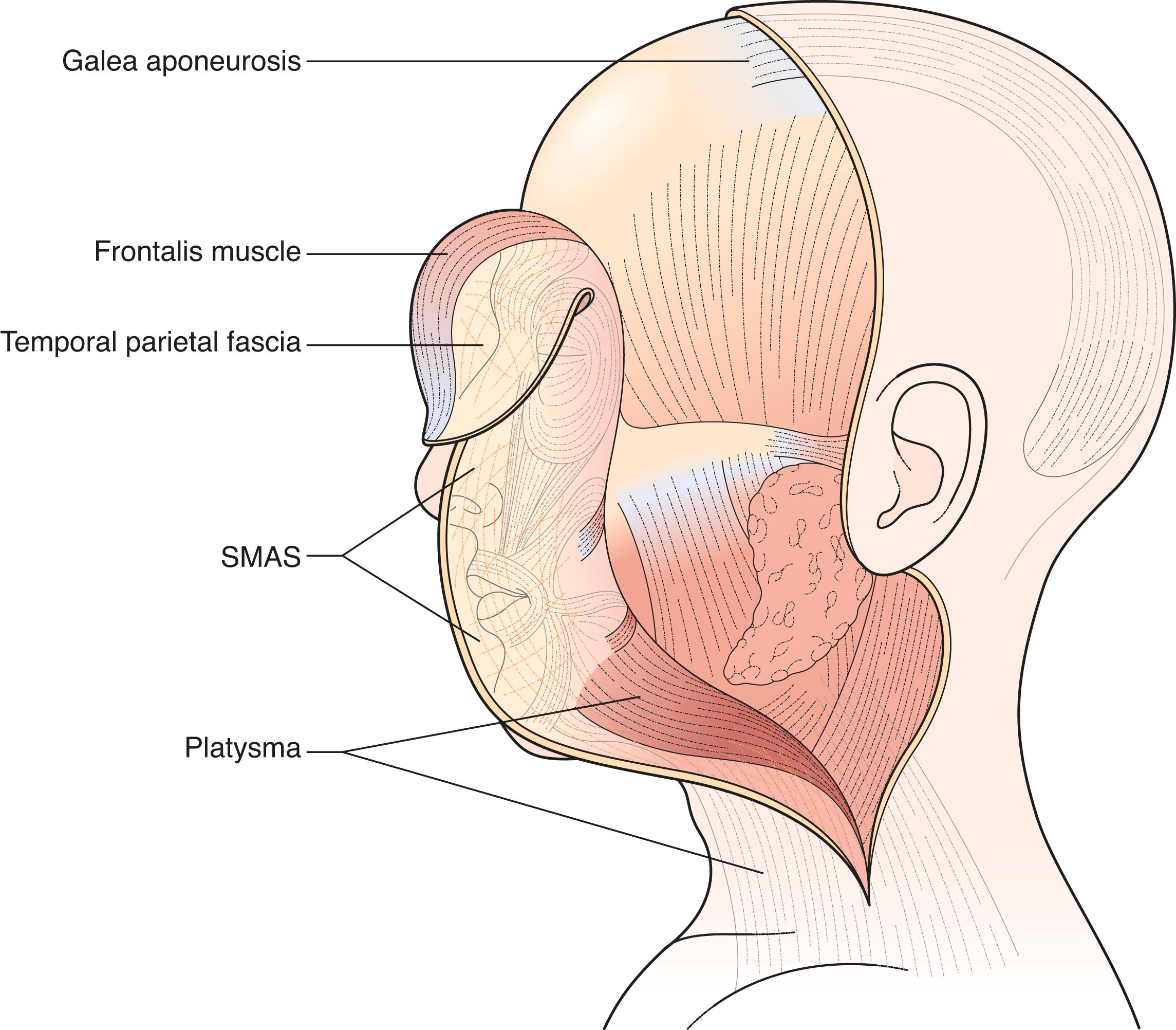 Figure 7.8, The SMAS and the analogous anatomic layers—a fibromuscular layer covers the face and skull. The SMAS (face) is continuous with the platysma muscle in the neck, temporoparietal fascia in the temple, and galea aponeurotica in the forehead and head.