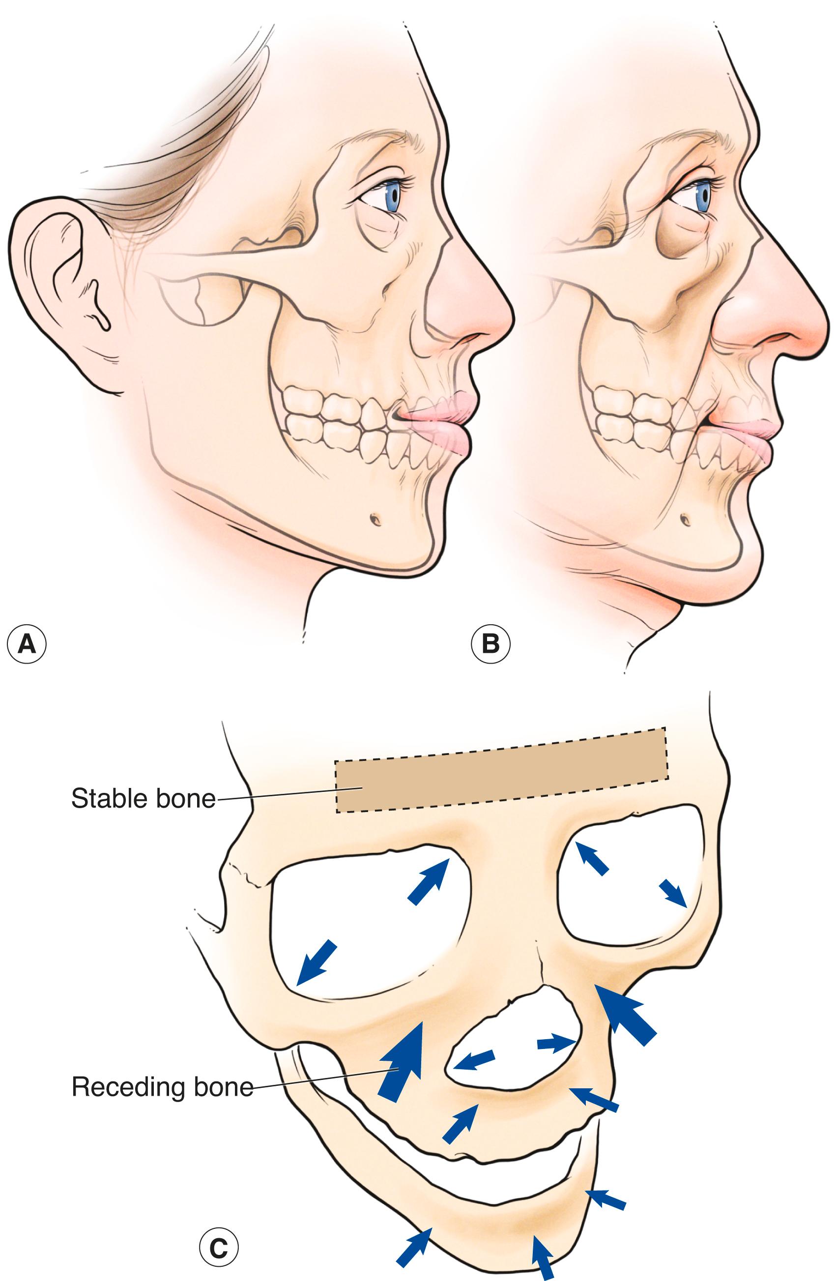 Figure 7.9, Facial bone changes with aging. ( A and B ) Bone atrophy occurs in the face, especially in the midface and mandible. This results in characteristic soft tissue changes, as well, including a nasal droop and a receding chin. ( C ) The atrophy occurs in proportion to the arrow size. Most of the change occurs in the midface in the area of the medial fat pad of the face. No changes occur on the forehead. If you look carefully at your older patients you notice these resultant facial changes to one degree or another.