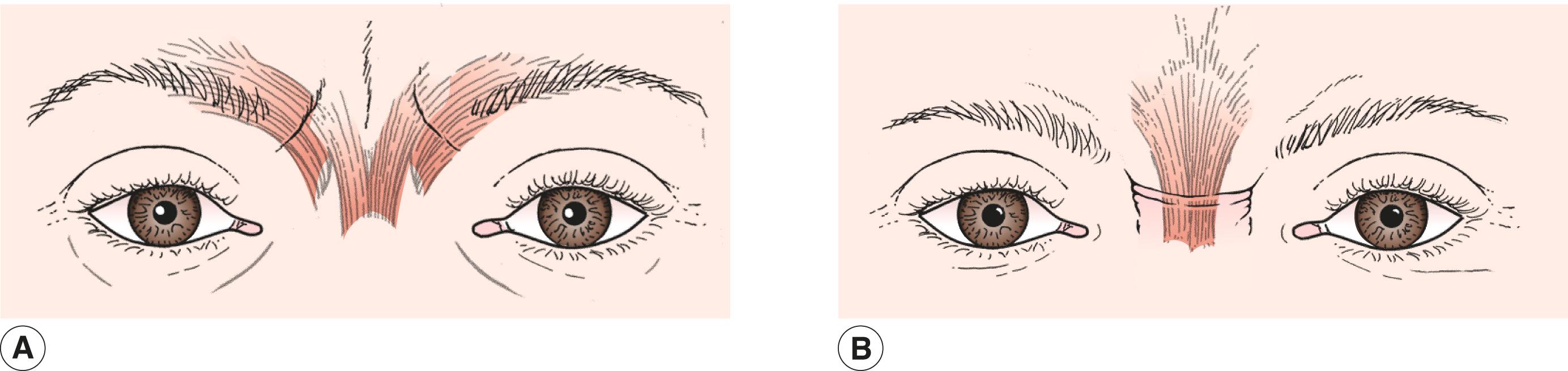 Figure 7.10, The glabellar furrows. ( A ) Corrugator muscle action causing vertical furrows in the glabella. ( B ) Procerus muscle causing horizontal furrows in the glabella.