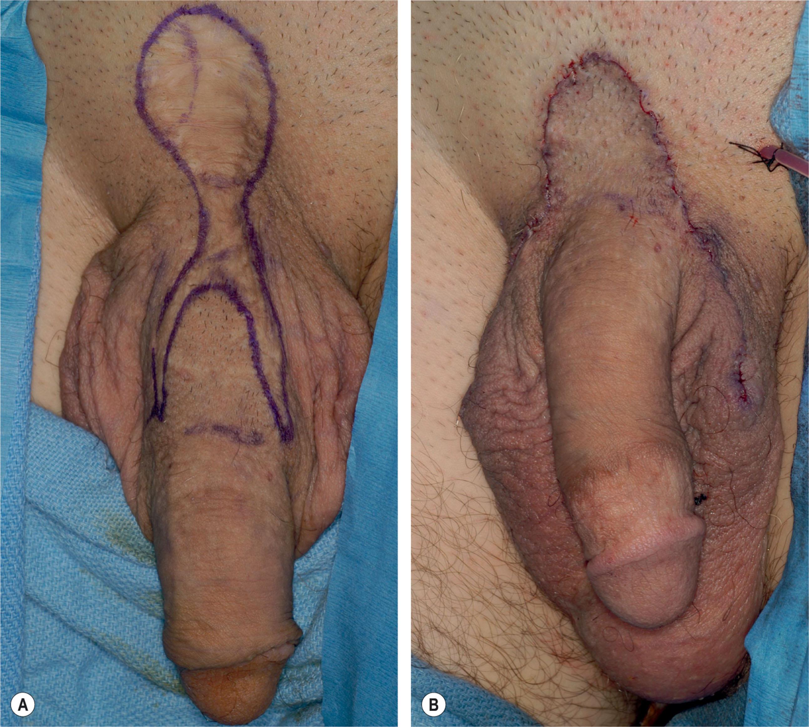 Figure 40.2, Complete reversal of V–Y advancement flap. (A) The scar is marked for excision. The marking at the base of the V–Y flap on the left is the estimated location for the reapproximation of the flap to the pubic hairline. (B) Complete reversal of the V–Y flap resulting in a semicircular incision line. Hair on the V–Y flap is aligned with the pubic hair.