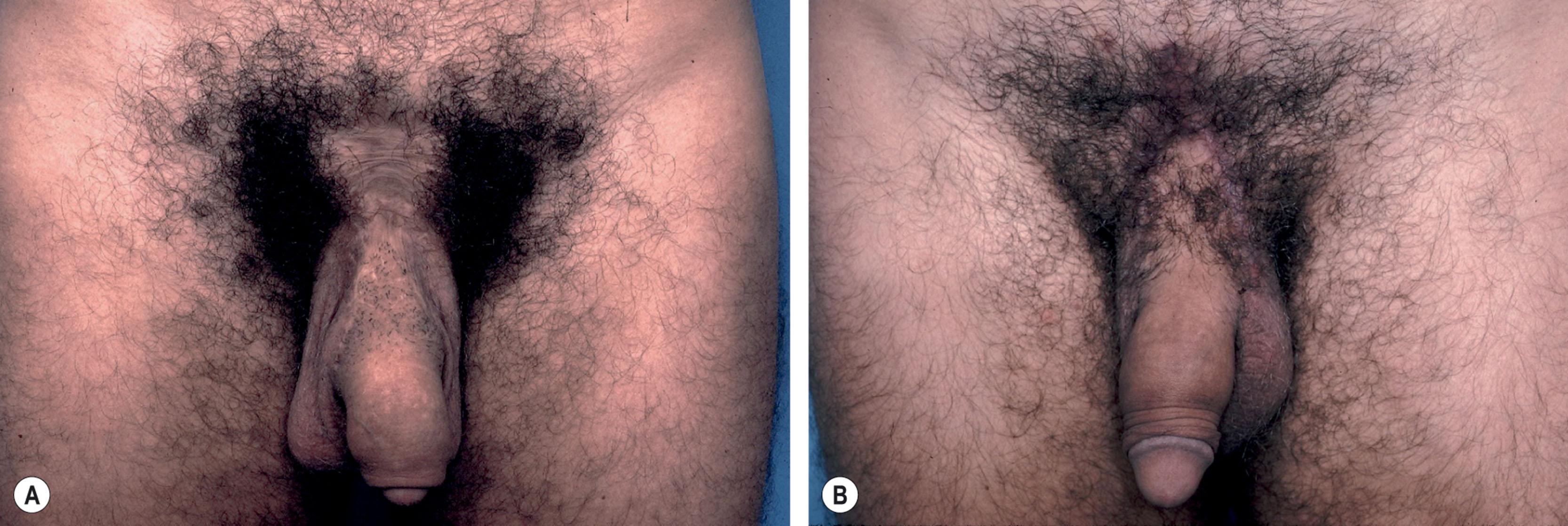 Figure 40.3, Patient who had release of the suspensory ligament, a large V–Y advancement flap, and fat injections. (A) The deformity shows a low-lying penis, hair on the proximal shaft, bilateral dog-ears at the penoscrotal junction, a short-appearing penis, wide pubic scars, and fat in the shaft. (B) Reconstruction after partial reversal of the V–Y advancement flap, correction of the V–Y dog-ears, scar revisions, and selective removal of fat. Complete reversal of the V–Y flap was not possible due to previous partial loss of a portion of the V–Y flap.