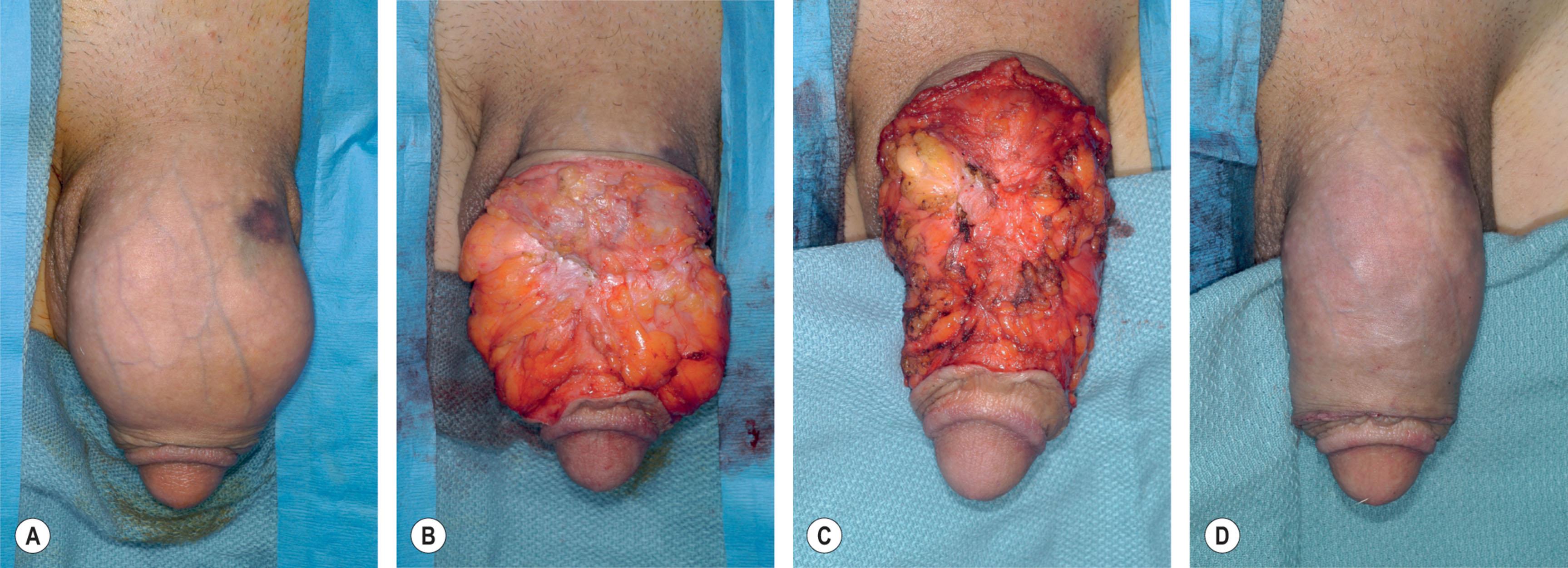 Figure 40.5, (A) Patient with large volume of injected penile fat that is causing obvious convexities. (B) Circumcision incision reveals diffuse fat deposits. (C) Residual fat after contouring. (D) Penis appearance after closure. It is very difficult to achieve ideal symmetrical contouring.