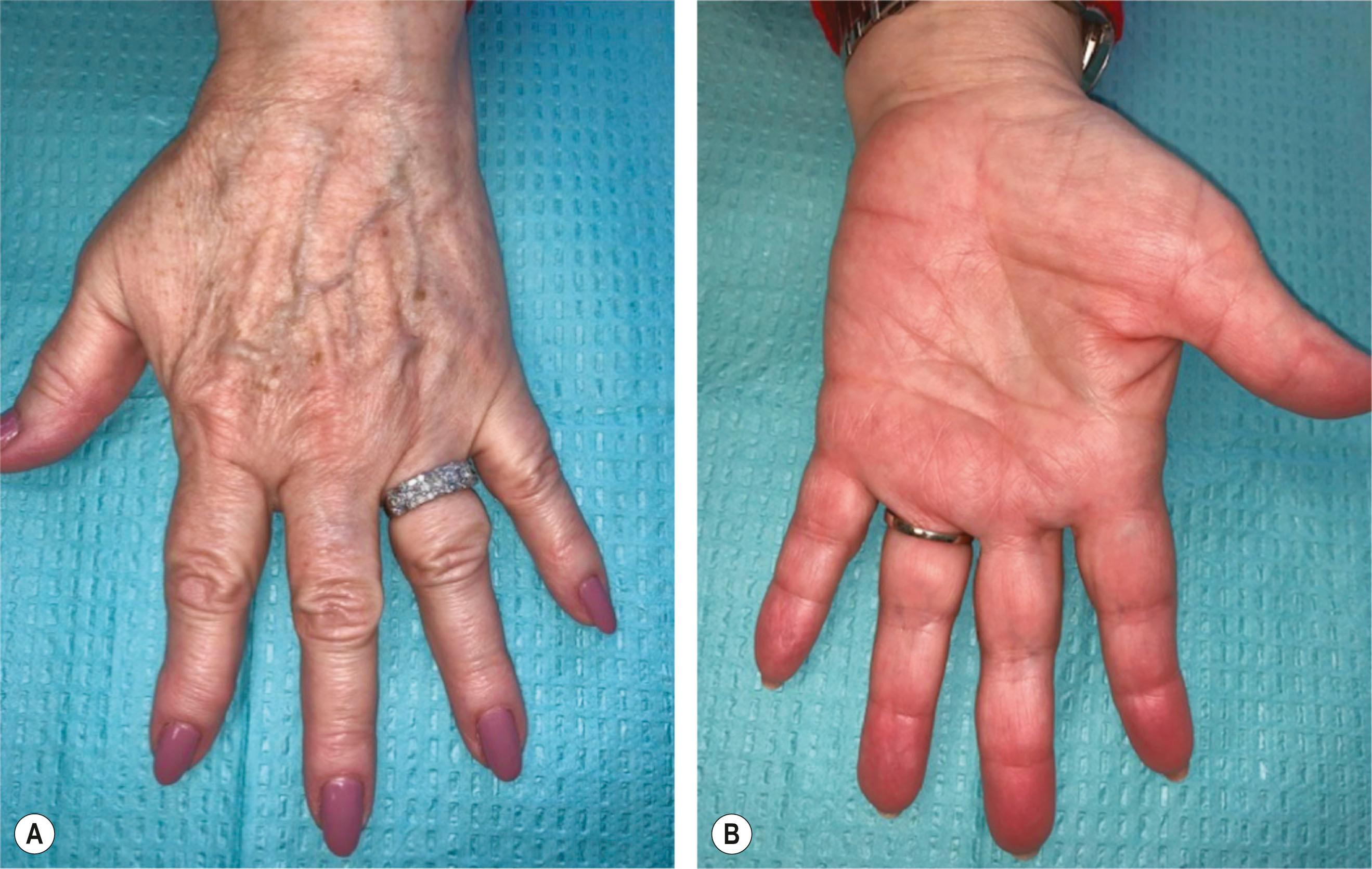 Figure 42.1, The aged hand. Dorsal aspect (A) and volar aspect (B) .