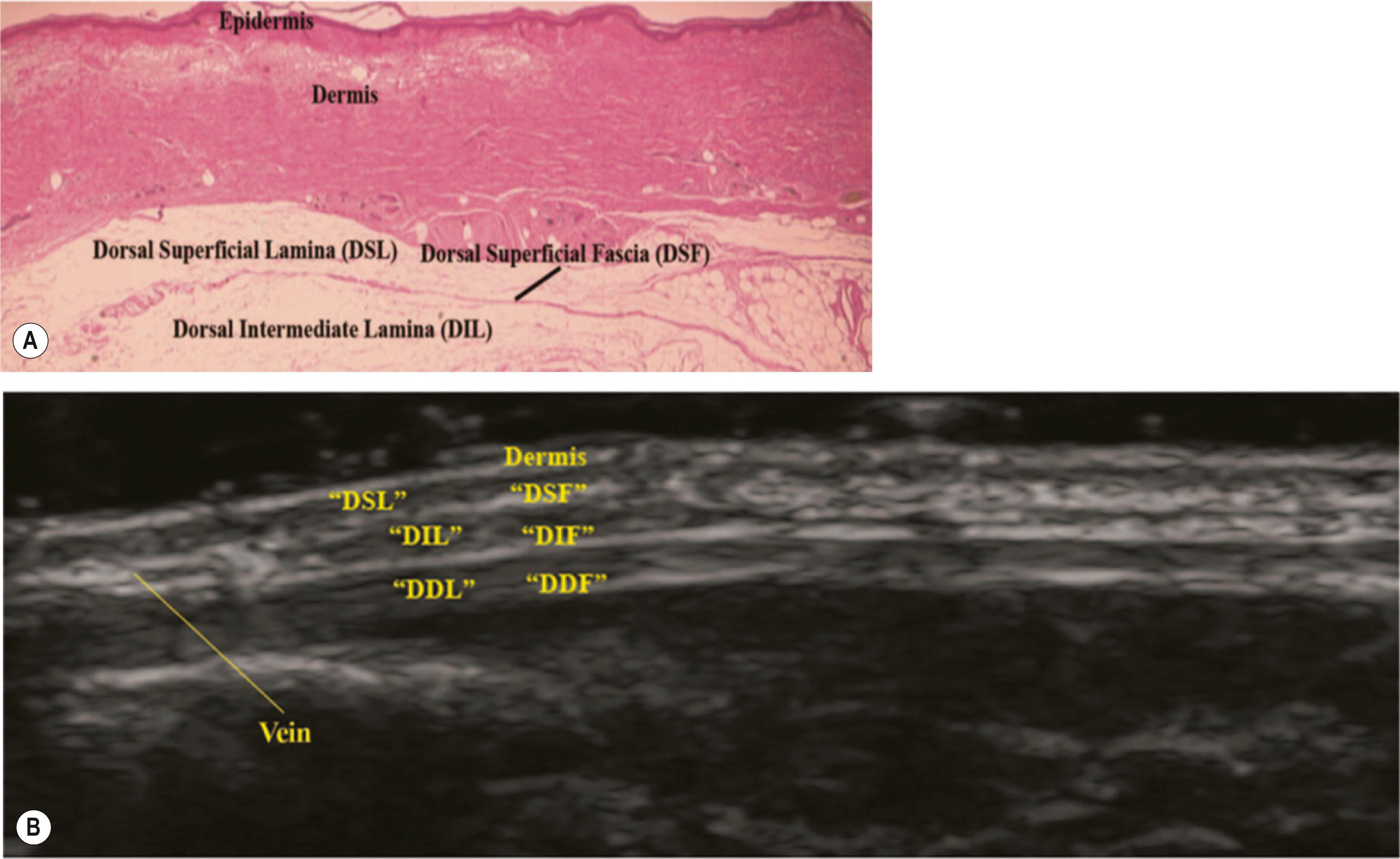 Figure 42.2, Anatomy of the dorsal hand. (A) Histologic slide demonstrating dorsal superficial lamina, dorsal superficial fascia, and dorsal intermediate lamina. (B) Duplex ultrasound image demonstrating sagittal section of hand, showing the veins in the dorsal intermediate lamina. DSL, Dorsal superficial lamina; DSF, dorsal superficial fascia; DIF, dorsal intermediate fascia; DDF, dorsal deep fascia; DDL, dorsal deep lamina.