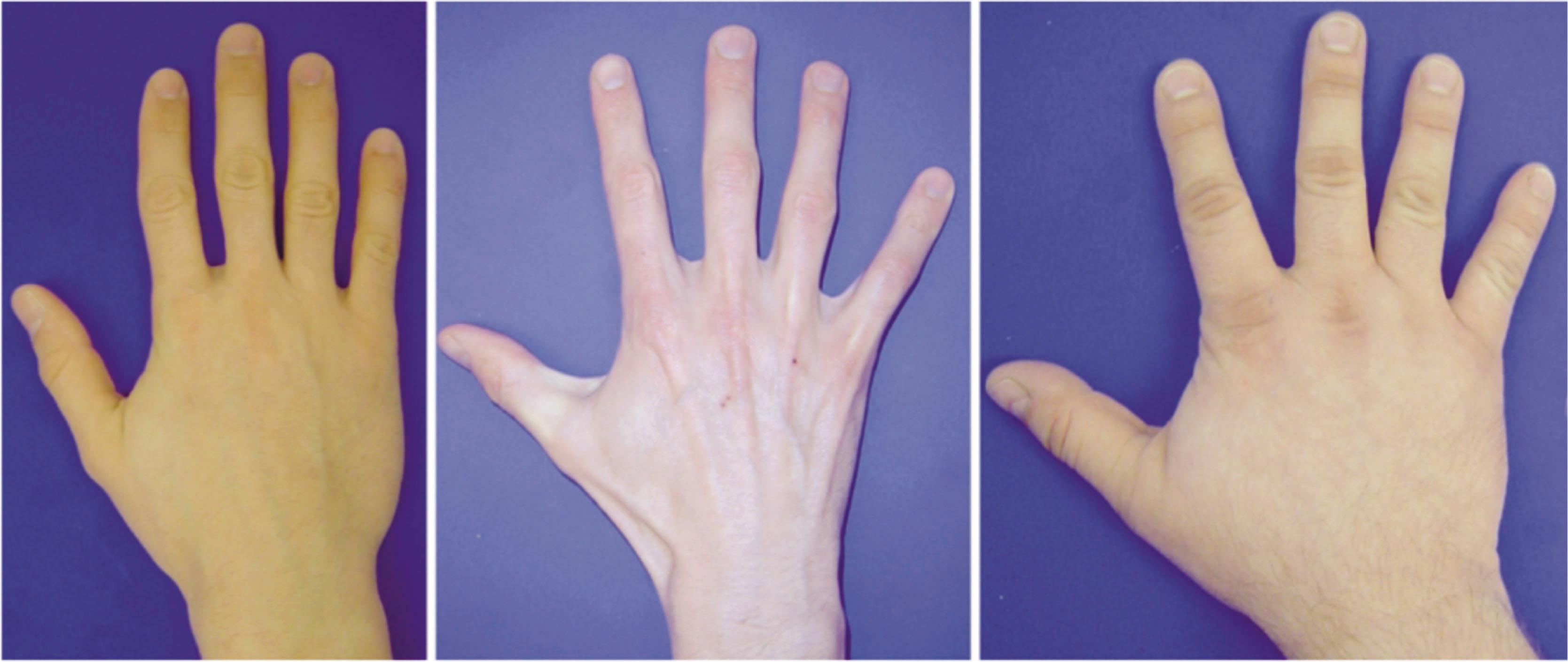 Figure 42.3, Hand types: (left to right) athletic, leptosome–aesthenic, and pyknic.