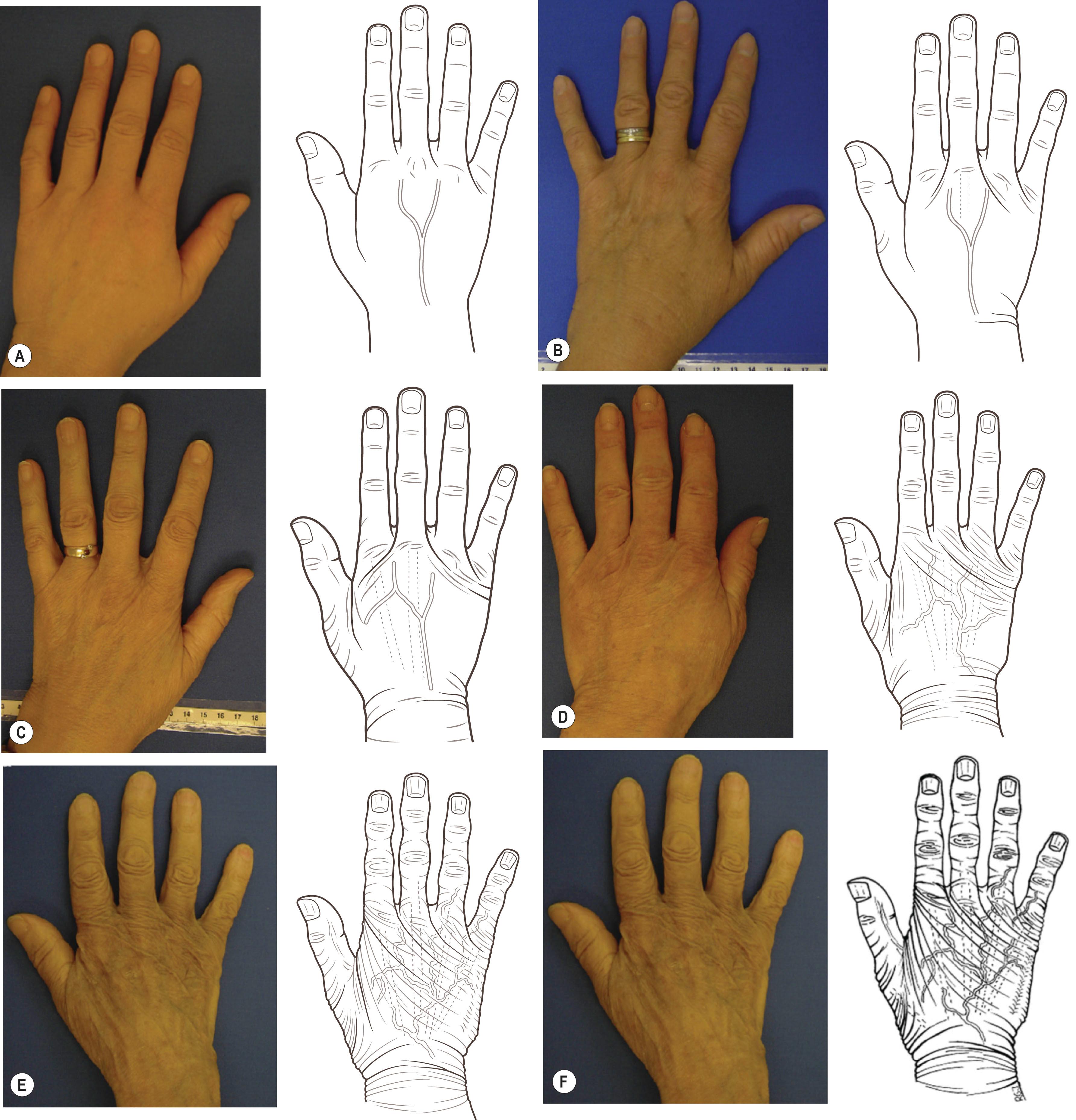 Figure 42.6, The aging process. (A) 4th decade; (B) 5th decade; (C) 6th decade; (D) 7th decade; (E) 8th decade; (F) 9th decade.