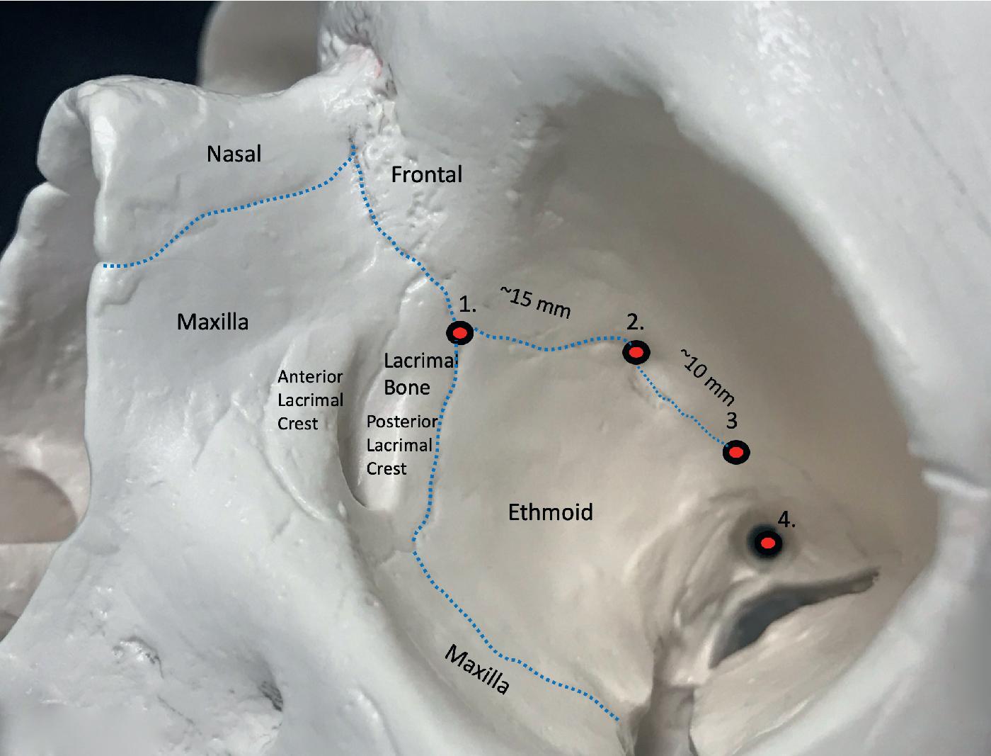 Fig. 33.2, Medial orbital anatomy. Key landmarks include the dacryon (1), the anterior ethmoidal foramen (2), the posterior ethmoidal foramen (3), and the optic canal (4).