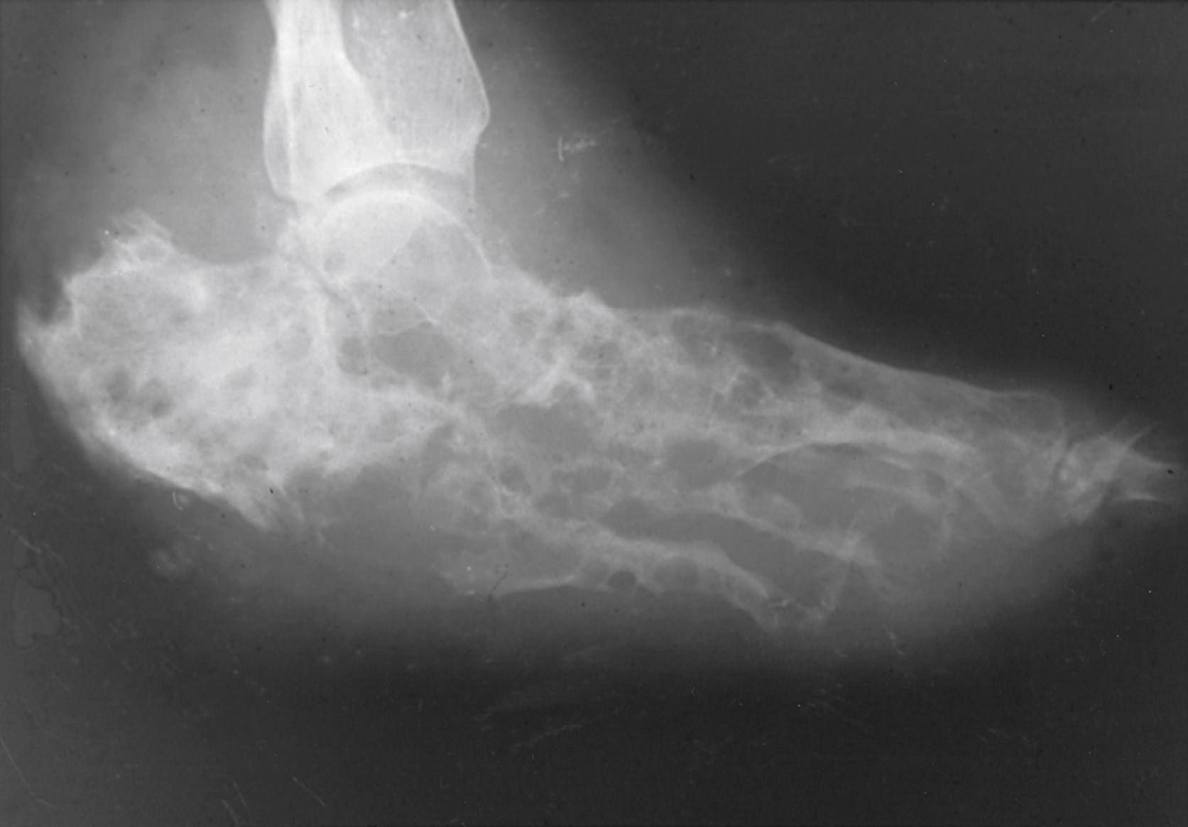 Figure 255.1, Radiograph of the foot of a 43-year-old farm worker with an 8-year history of foot swelling and fistulous drainage of suppurative material. Madurella mycetomatis was isolated from exuded granules. The radiograph shows extensive destruction of all bones of the foot with characteristic multiple lytic cavities and almost complete loss of normal bony architecture.