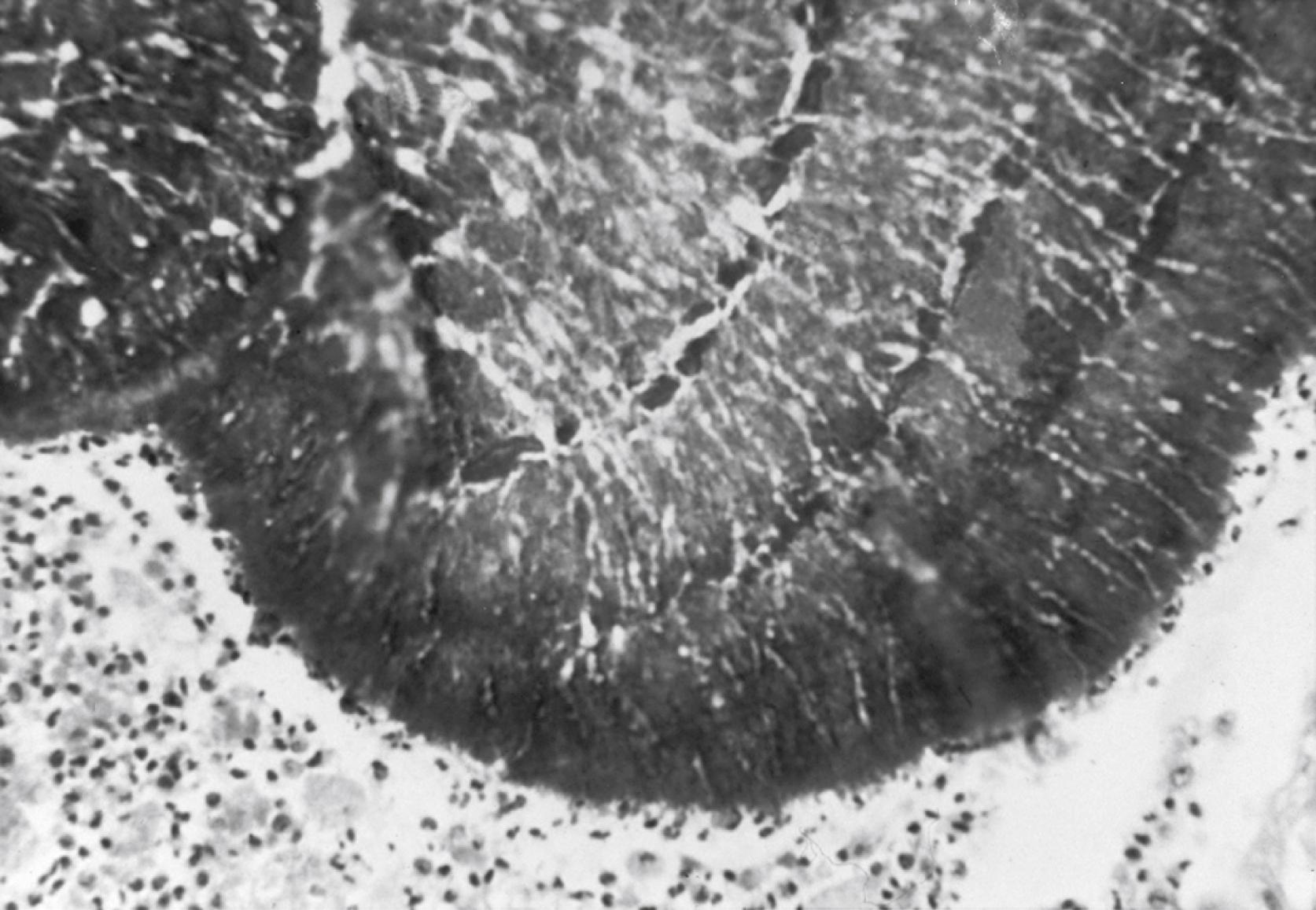 Figure 255.2, Hematoxylin and eosin−stained section of a brownish granule of Madurella mycetomatis containing radially oriented hyphae within a matrix of cement-like material. The granule is located within an abscess and is surrounded by acute inflammatory cells (original magnification, ×200).