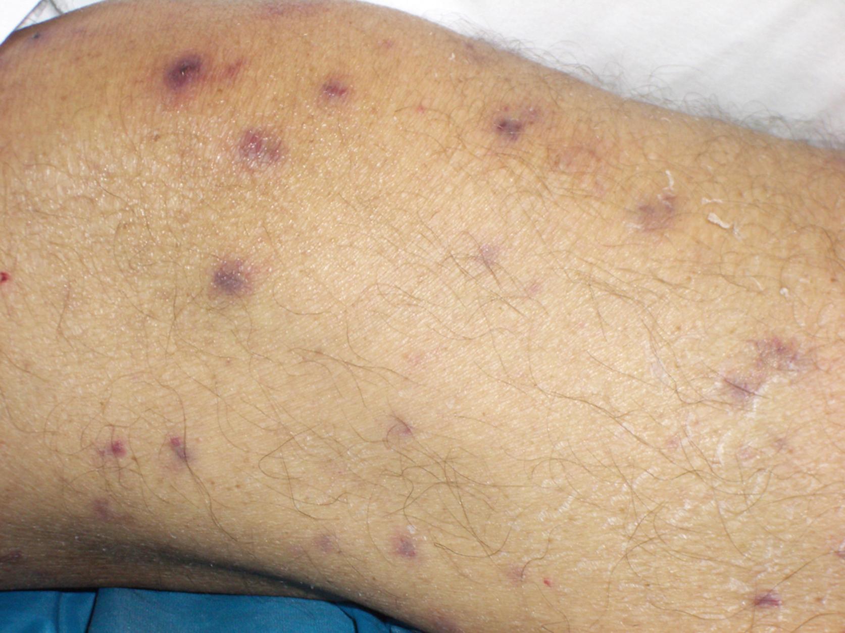 FIGURE 245.1, Typical necrotic-appearing skin lesions of Fusarium infection on the arm of a patient with disseminated disease.