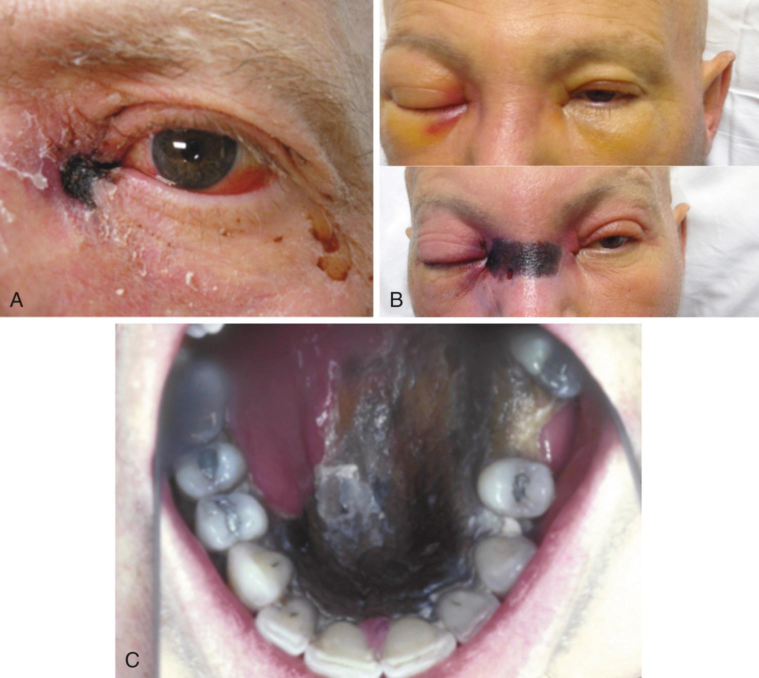 FIG. 258.4, Sino-orbital involvement of mucormycosis.