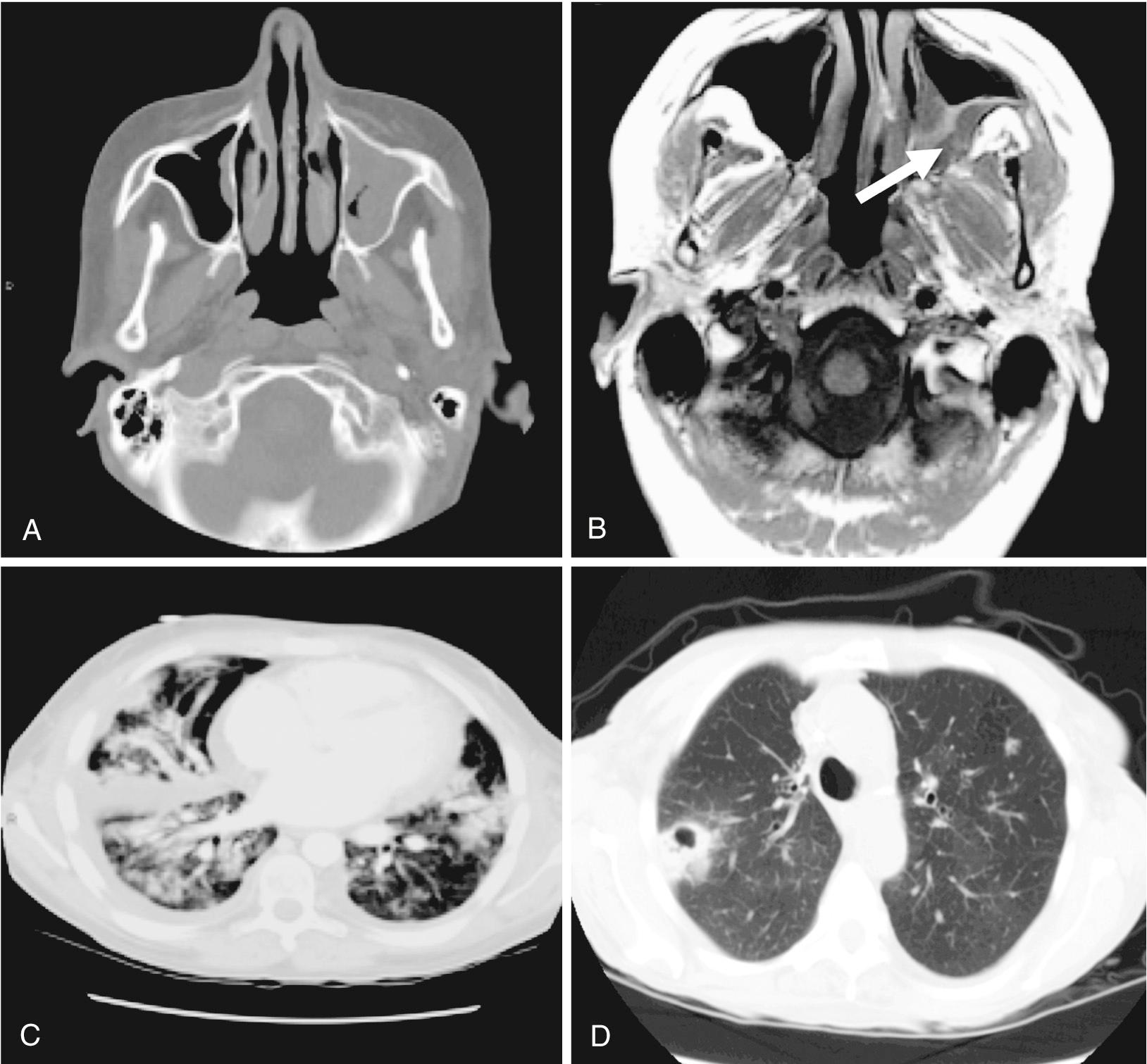 FIG. 258.5, Radiographic findings in sinopulmonary mucormycosis.