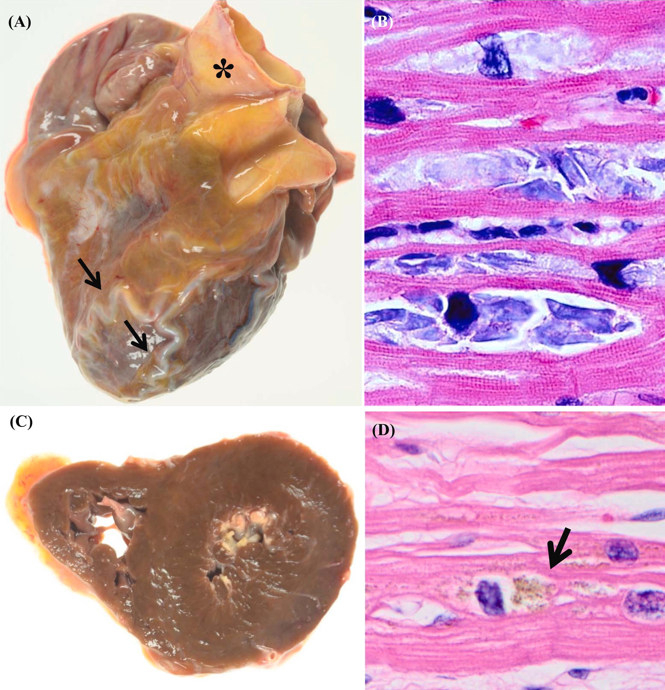 Figure 3.1, Common cardiac findings in the elderly: (A) Atrophic heart from 91-year-old male (Heart weight = 167 g). Gelatinous changes of epicardium (serous atrophy of fat) with tortuous coronary arteries (arrow). Note ascending aorta (*) appears disproportionately large compared to the size of the heart. (B) Basophilic degeneration of the cardiomyocytes (basophilic, finely granular materials, H&E stain, ×400). (C) Brown atrophy of the heart. (D) Increased lipofuscin pigment (brown granules, H&E stain, ×400).