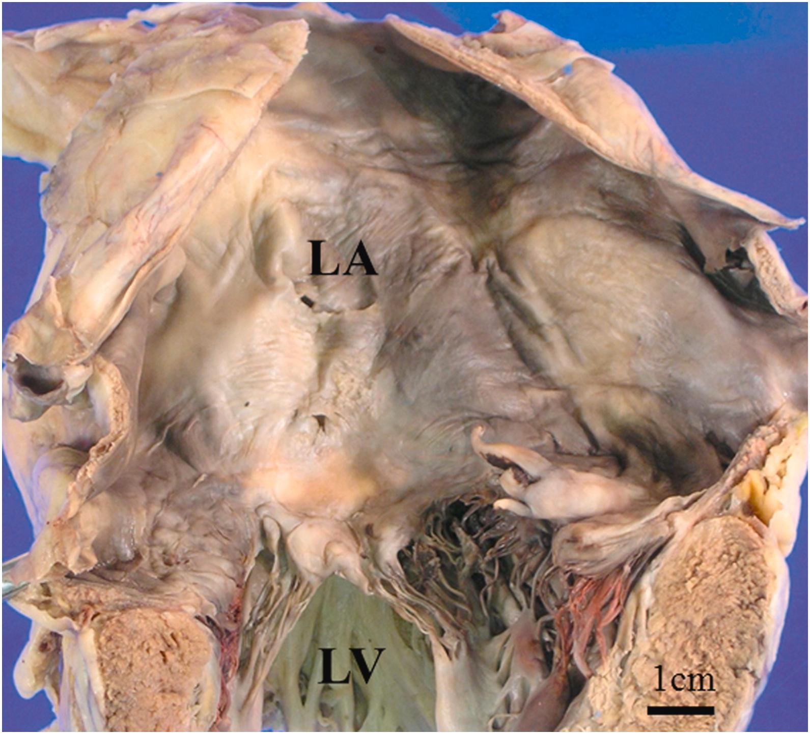 Figure 3.2, Dilated left atrium (LA). LV , left ventricle.