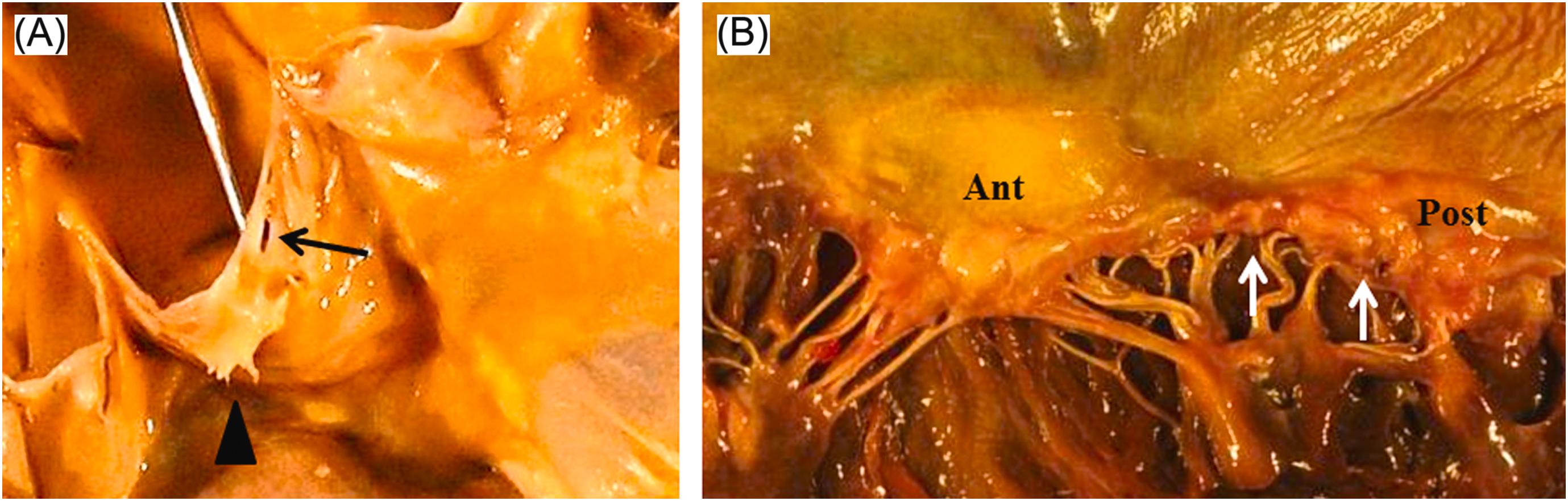 Figure 3.4, Common valvular changes in the elderly: (A) Fenestration (black arrow) and Lambl’s excrescence (arrow head) in the aortic valve cusp. (B) Anterior leaflet (Ant) of mitral valve demonstrates increased valve thickness and lipid deposition. Posterior leaflet (Post) of mitral valve is thickened and opaque with hooding (white arrows).