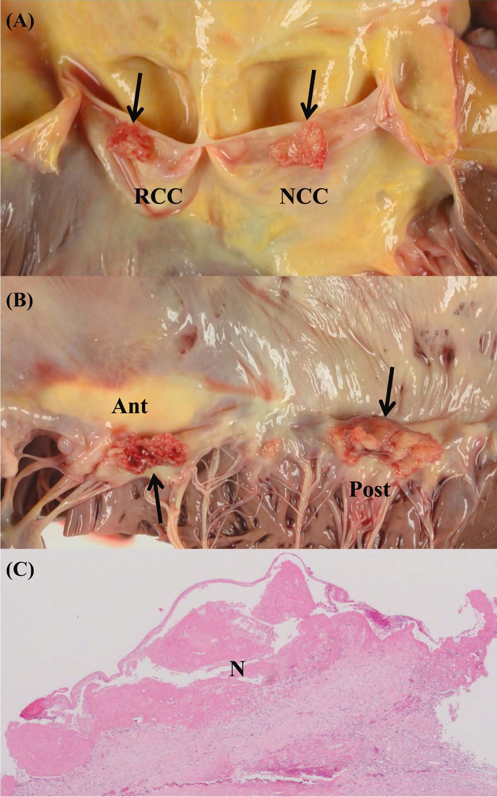 Figure 3.5, Common findings in elderly valves: (A) Nonbacterial thrombotic endocarditis (NBTE, arrows) on the right-coronary cusp (RCC) and noncoronary cusp (NCC) of the aortic valve. This 84-year-old male had gastric adenocarcinoma. (B) NBTE (arrows) on the anterior (Ant) and posterior (Post) leaflets of mitral valve from the same patient. Note there are no destructive vegetations on the valve leaflets, and NBTE vegetations are easily removed from the surface of the valve leaflets. (C) Histologically, NBTE (N) is composed of fibrin and platelets (H&E stain, ×20).