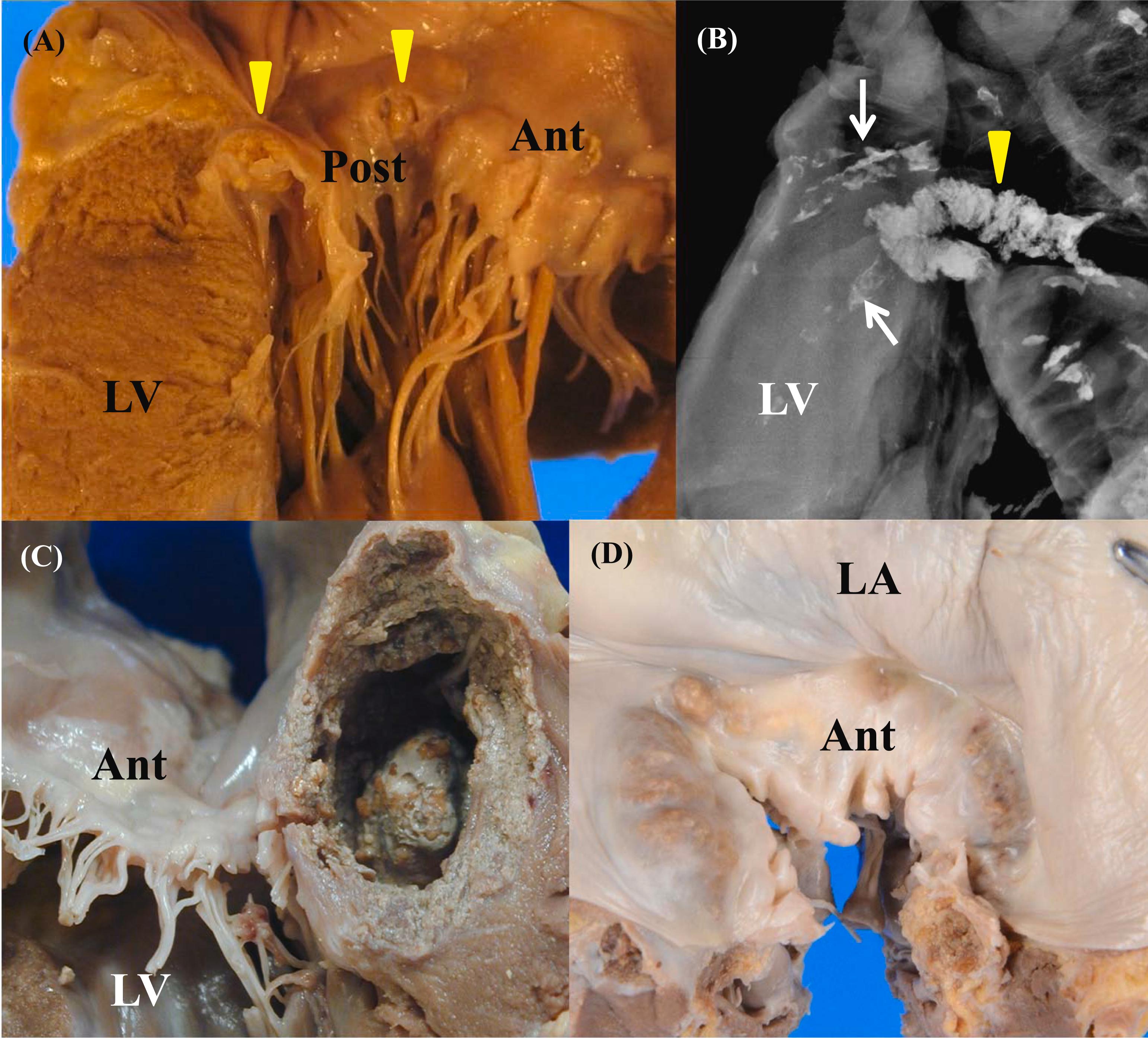 Figure 3.6, Mitral annular calcification (MAC): (A) Nodular calcification (arrow heads) is present deep to the posterior leaflet (Post) of the mitral valve. A calcific nodule is projecting toward the left atrium. Ant , anterior leaflet. (B) An X-ray of the same specimen. MAC (arrow head) is found at the atrioventricular ring. MAC forms a C-shaped subvalvular shelf. Calcified coronary arteries (arrows) are also seen in the left ventricle (LV). (C) A massive MAC. (D) O-shaped MAC. LA , left atrium.