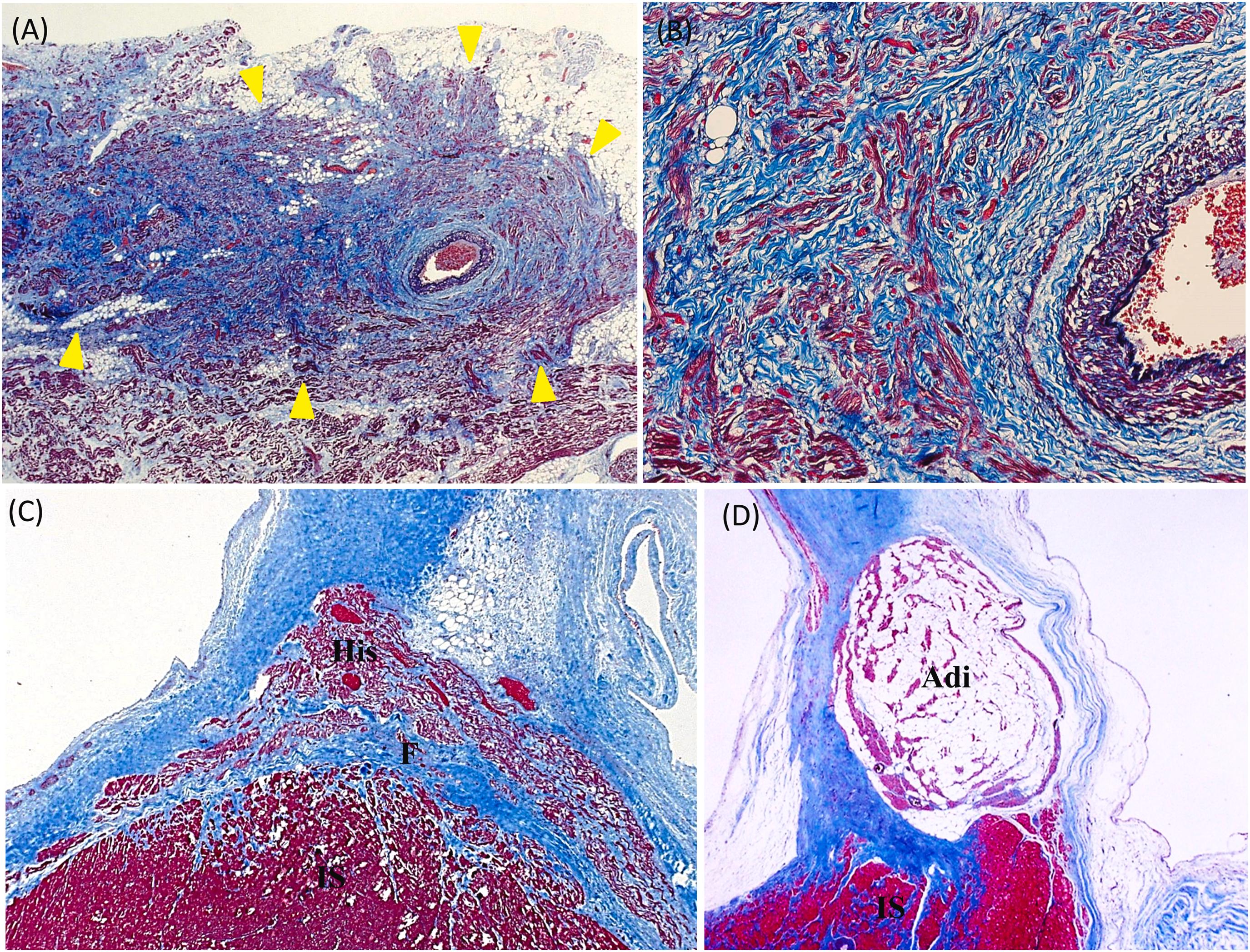 Figure 3.7, Age-related changes in the conduction system (A, B, C, and D, Trichrome and Elastic Van Gieson stains; A, C, and D, ×20; and B, ×400): (A) Sinoatrial (SA) node (arrow heads) showing increased collagen fibers (blue). (B) Higher magnification demonstrates the SA nodal cells (red) surrounding the SA node artery with increased collagen fibers (blue). (C) Section showing the bundle of His (His) with fibrosis (F) at the base of the interventricular septum (IS). (D) Section showing the atrioventricular (AV) node infiltrated by adipose tissue (Adi).