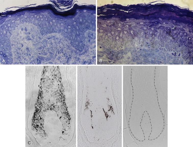 Figure 25-1, Human skin and hair follicle changes with age. A, Toluidine blue–stained vertical section of male forearm skin (32-year-old man; ×1200). B, Toludine blue-stained vertical section of male forearm skin (67-year-old man; ×1200). C, Unstained vertical sections (×1000) of lower anagen scalp hair follicles of 23-year-old man (pigmented, left ), 66-year-old woman (graying, middle ), and 55-year-old woman (white, right ).