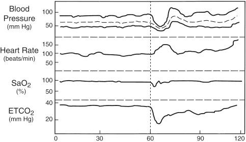 Fig. 127.1, Schematic trend recording of blood pressure, heart rate, oxygen saturation (Sa o 2 ), and end-tidal carbon dioxide (ETCO 2 ) concentration in an 8-week-old infant during sagittal craniosynostosis repair.