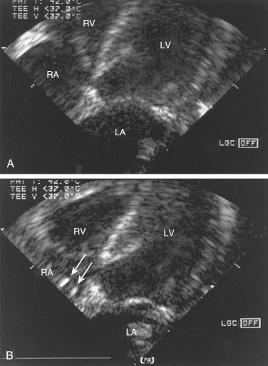 Fig. 127.2, Transesophageal echocardiographic four-chamber view of the left atrium (LA), right atrium (RA), left ventricle (LV), and right ventricle (RV).