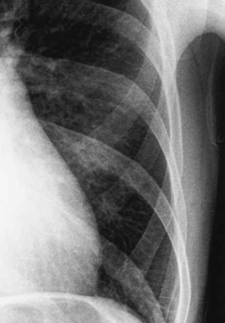 Magnified view of the left costophrenic region demonstrating multiple interstitial (Kerley B) lines. Each line is roughly perpendicular to the chest wall and extends to the pleural surface. *