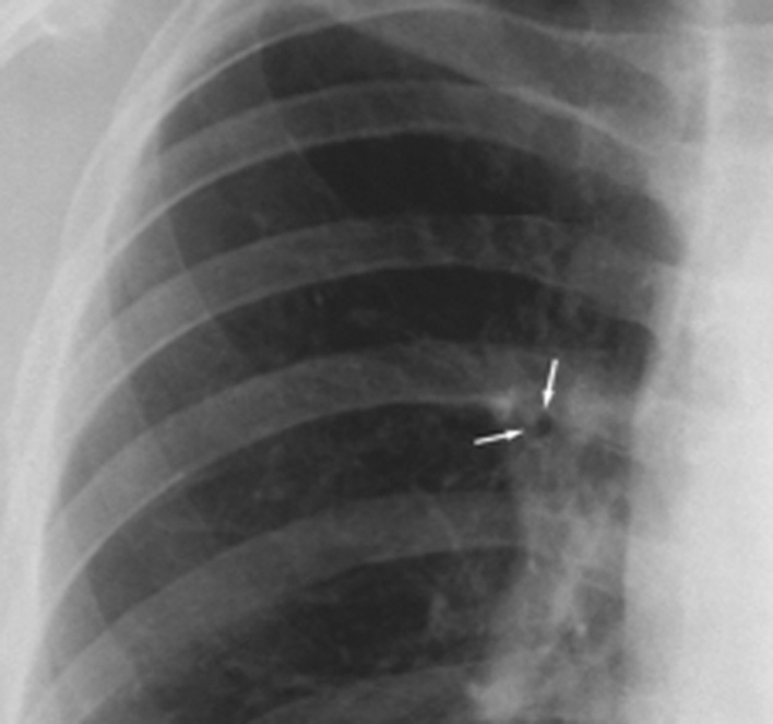 Peribronchial cuffing. The wall of the anterior segmental bronchus appears thickened and ill-defined (arrows) in early interstitial oedema due to (iatrogenic) fluid overload. *