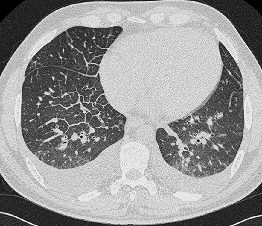 Pulmonary oedema on CT. There is diffuse ground-glass opacification, smooth thickening of multiple interlobular septa and peribronchovascular cuffing. Bilateral pleural effusions are also seen. *