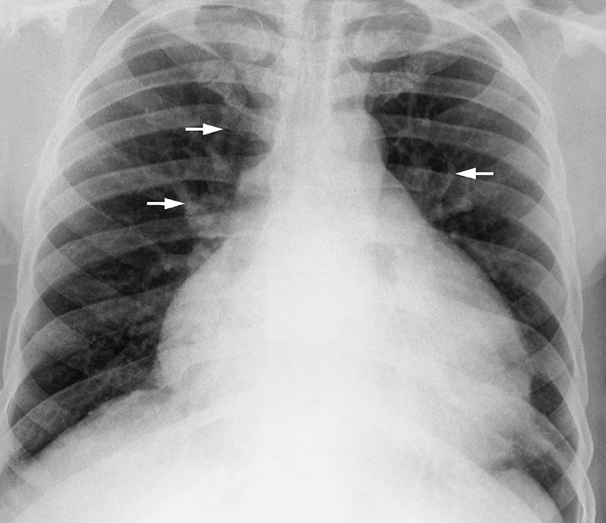 Upper lobe blood diversion. Vessels in the upper zones (arrows) are prominent in comparison to those in the lower lung zones. *