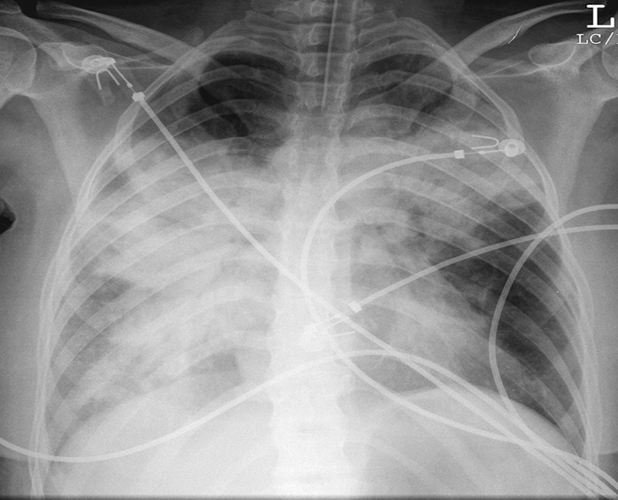 Pulmonary oedema on CXR demonstrating the characteristic ‘bat's wing’ distribution, with airspace opacification principally within the central lung. *