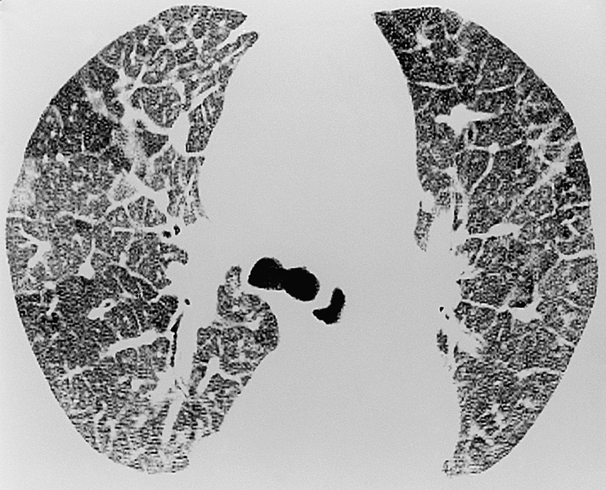 Generalized thickening of the interlobular septa on a background of ground-glass opacification in a patient with cardiogenic pulmonary oedema. ©2