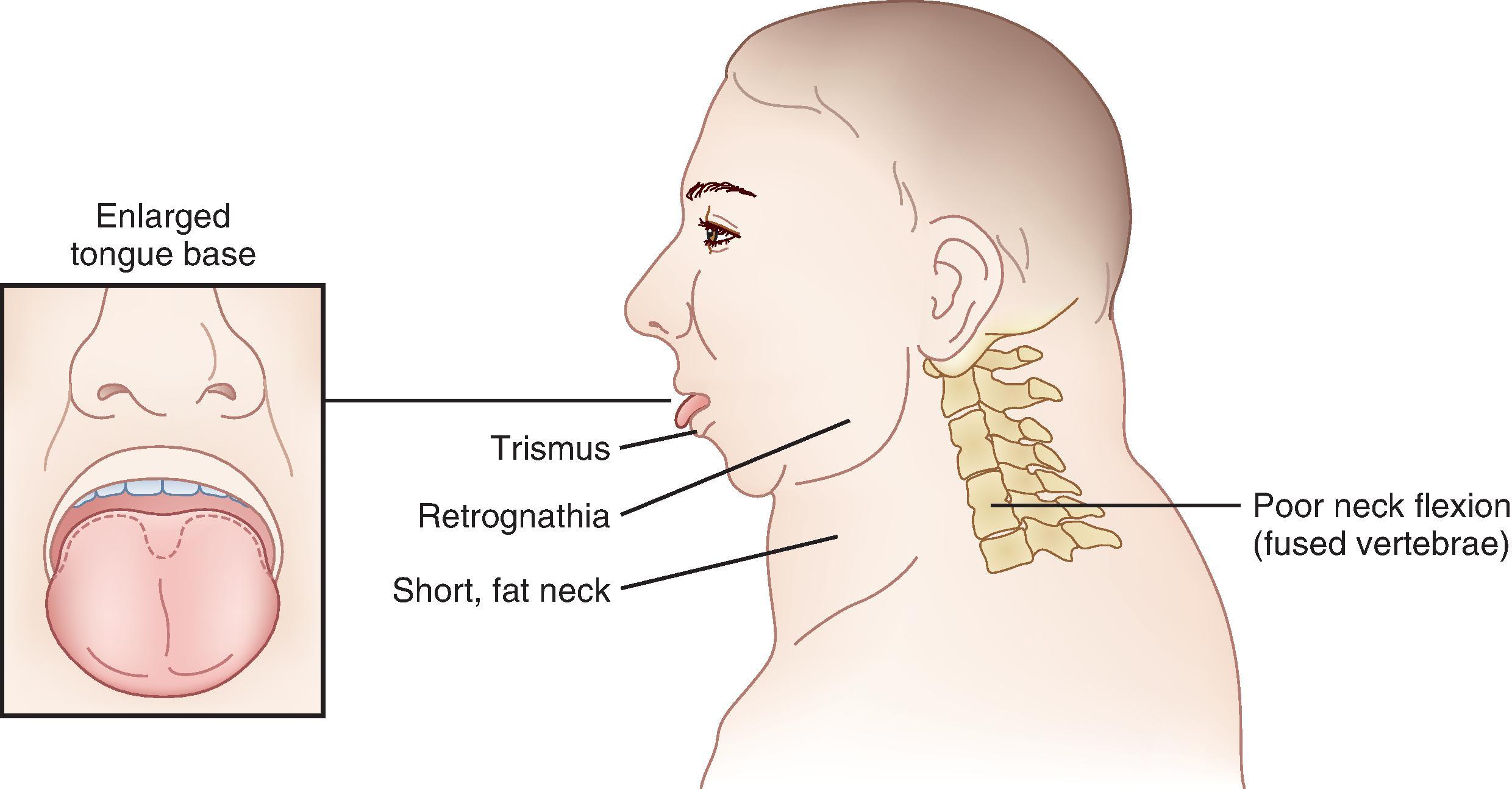 Fig. 38.12, Anatomic features associated with a difficult airway exposure during operative laryngoscopy and rigid bronchoscopy. Difficult laryngeal exposure may be encountered in patients with retrognathia; lingual hypertrophy or poor palatal visualization; trismus or reduced interincisor opening; short, thick neck; and limited neck extension.