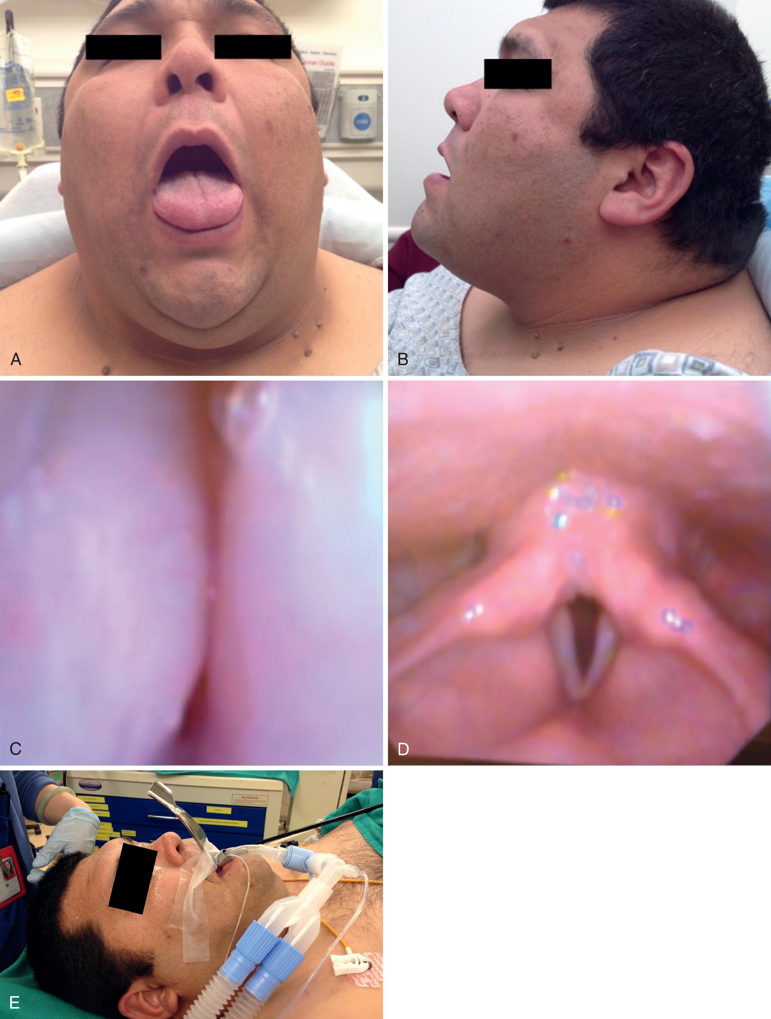 Fig. 38.13, (A–E) The value of the preoperative endoscopic airway examination (PEAE) in the management of an anticipated difficult airway. (A, B) Note the patient’s external airway features associated with the anticipated difficult airway: morbid obesity, a Mallampati class IV airway, decreased mandibular protrusion, decreased atlanto-occipital extension, and a short, thick neck. (C) PEAE demonstrates the “kissing” tonsils, (D) a normal posterior airway, clear pyriform sinuses, and absent laryngeal pathology. (E) The PEAE negative findings were reassuring for an asleep approach to tracheal intubation, which was uneventfully accomplished via the LMA Fastrach (E).