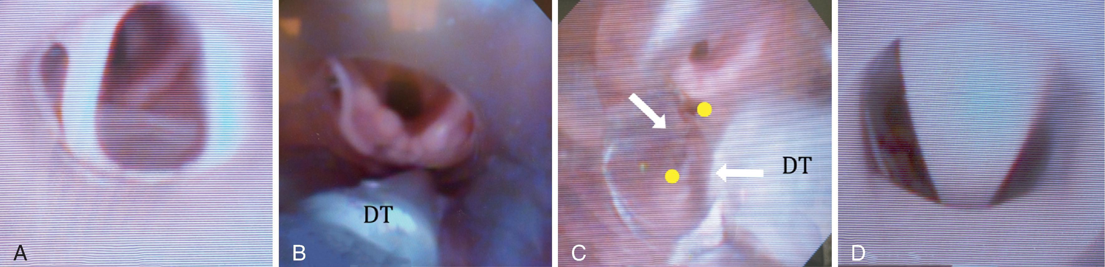 Fig. 38.14, A flexible scope view through the different laryngeal mask airways (LMAs) during the LMA-endotracheal tube (ETT) exchange. The important differences in the flexible intubation scope (FIS)-guided airway exchange through different types of supraglottic airway (SGA) devices. Establishing the landmark endoscopic view inside the SGA is the essential first step for such an exchange. The LMA family of devices is used commonly and was selected for this demonstration. (A) A flexible scope view of the aperture bars of the LMA Unique/Classic. The LMA-endotracheal tube exchange is commonly facilitated using the Aintree intubation catheter (AIC), which is advanced off the flexible intubating scope (FIS) through the LMA aperture bars into the patient’s trachea, followed by the ETT-AIC exchange. (B) A flexible scope view of the laryngeal inlet through the airway tube of the LMA Proseal (pLMA). Note the improved access to the larynx as compared with the LMA Unique/Classic. The pLMA-ETT exchange is most easily performed using the AIC DT-drainage tube. (C) A flexible scope view on the exit from the airway tube of the LMA Supreme (sLMA). The FIS can be directed either to the left (pictured) , or to the right of the sLMA drainage tube ( DT ). Note the SLMA fins (white arrows) , creating two distinct channels (yellow dots) for the passage of the flexible fiberoptic bronchoscope (FFB). It is advisable to direct the FIS above the fins to achieve greater maneuverability with the FIS scope. The sLMA-ETT exchange is most easily performed using the AIC. (D) A flexible scope view of the epiglottic elevator bar (EEB) inside the LMA Fastrach. The space around the EEB is not sufficient to pass the FFB. As opposed to the other SGAs, the airway exchange should be led by the tip of the ETT to elevate the EEB first, thus clearing the way for the FFB advancement into the patient’s trachea. The AIC can be used to facilitate this exchange but is not essential.