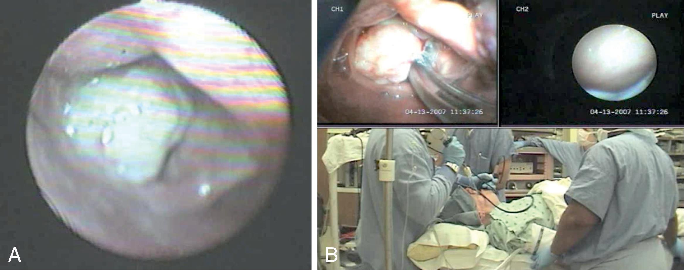 Fig. 38.15, A combined intubation technique using the Glidescope and the Shikani optical stylet (SOS) in a patient with a glottic tumor. (A) A ball valve laryngeal tumor seen on preoperative endoscopic airway examination (PEAE). Note a small glottic opening at the inferior-right side of the larynx (toward the 5 o’clock direction), allowing for a successful combined endoscopic approach. (B) A combined video intubation sequence with the Glidescope video laryngoscope (operator’s left hand) and an SOS (operator’s right hand). With the video laryngoscopy–enabled wide laryngeal exposure (left upper field), the optical stylet with the preloaded endotracheal tube is carefully maneuvered around the mass into the glottic opening (right upper field).