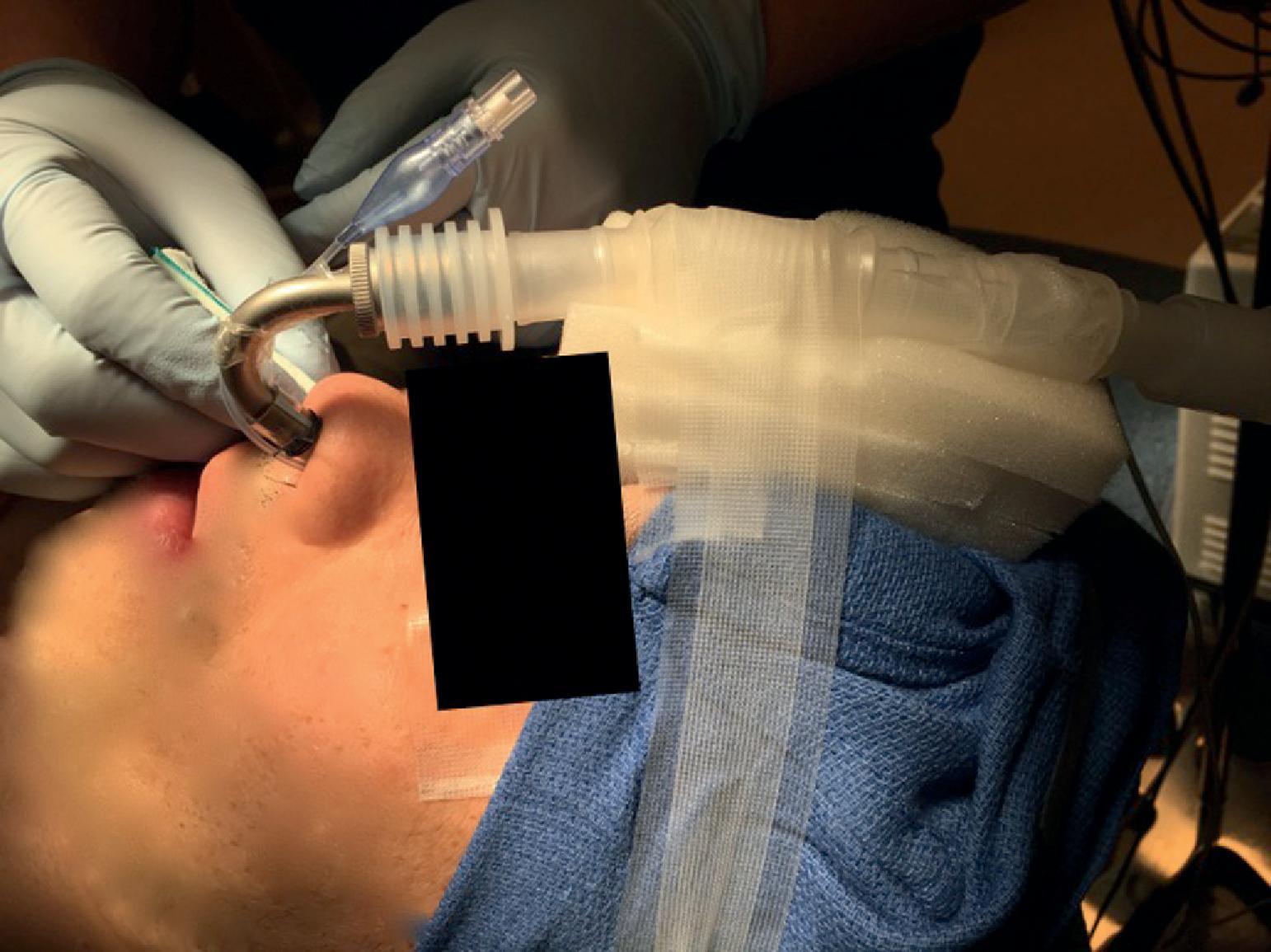 Fig. 38.2, Secure positioning of the nasally placed 6.0-mm-ID microlaryngeal tube (MLT). Note the montage of the anesthesia circuit to prevent pressure of the MLT tube against the nasal alar area to avoid alar necrosis. A similar montage is frequently used for securing the positioning of the preformed nasal RAE endotracheal tubes (ETTs). The additional suturing of ETTs to the nasal septum may be required for extra ETT stability.