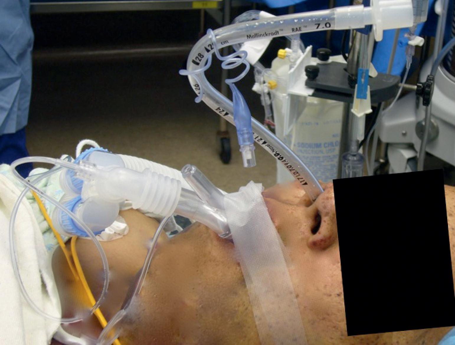 Fig. 38.3, A delayed sequence nasal intubation. A delayed sequence nasal intubation involves optimizing the patient’s oxygenation with the supraglottic airway (SGA) device before nasal intubation. It also frees the anesthesia provider’s hands to accomplish a nasal prep in an unhurried manner. The use of the SGA device with superior ventilation capabilities, such as the pictured LMA Supreme, is recommended to prolong apnea time in patients with decreased oxygen reserve (e.g., obesity), or when difficult mask ventilation is encountered or anticipated. The SGA is removed immediately before tracheal intubation.