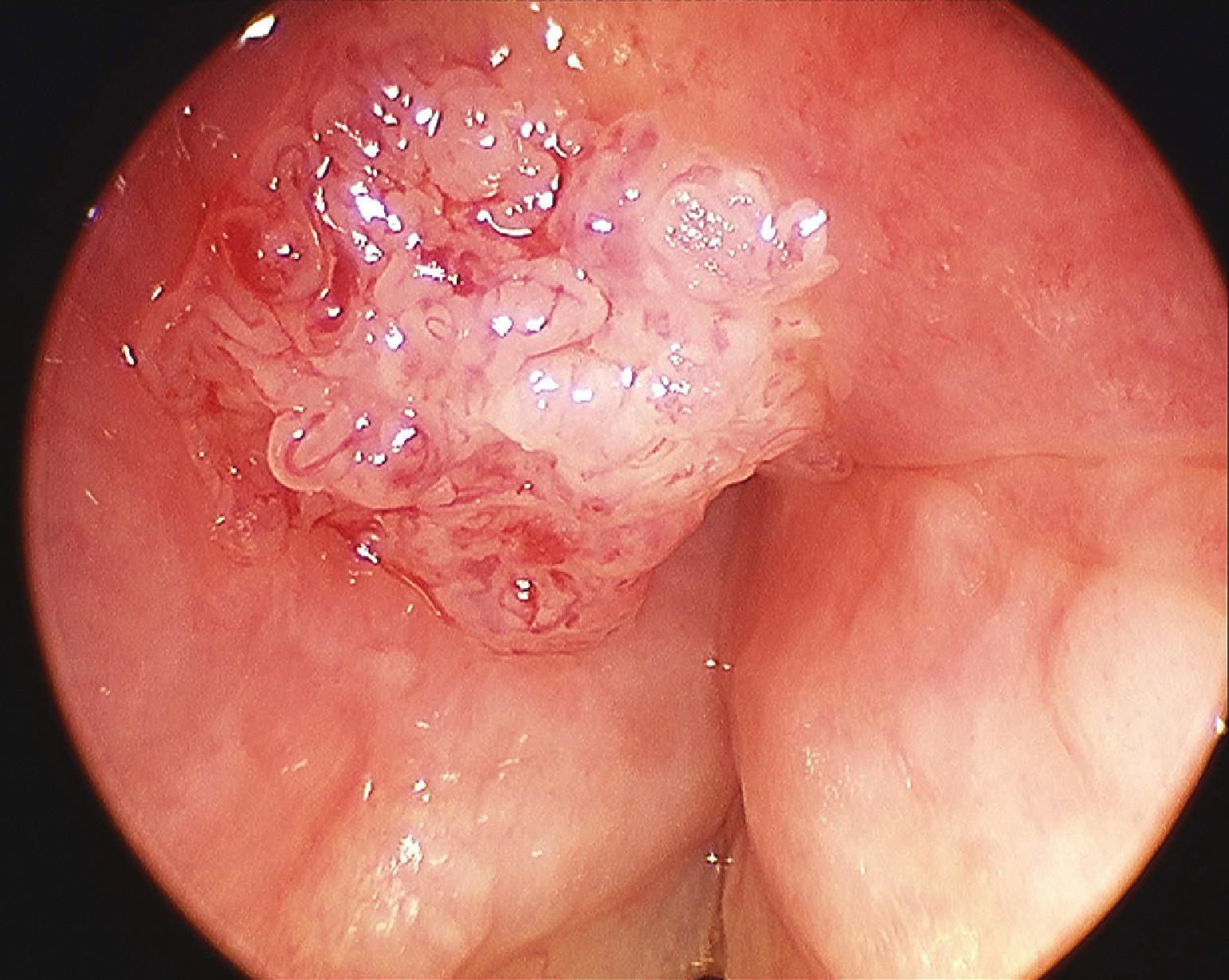 Fig. 38.5, Epiglottic carcinoma.