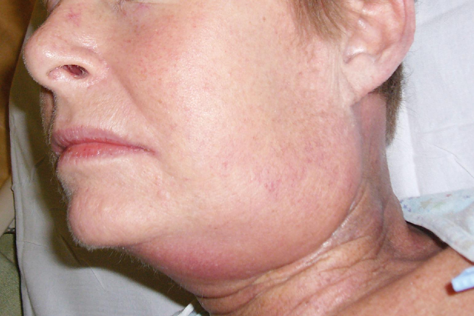 Fig. 38.6, Postradiation neck changes and decreased submandibular compliance in a patient presenting for panendoscopy. Note the postincisional neck scar and postradiation changes that have resulted in fibrotic changes in the skin and subcutaneous tissues of the neck and induration of the submandibular space.