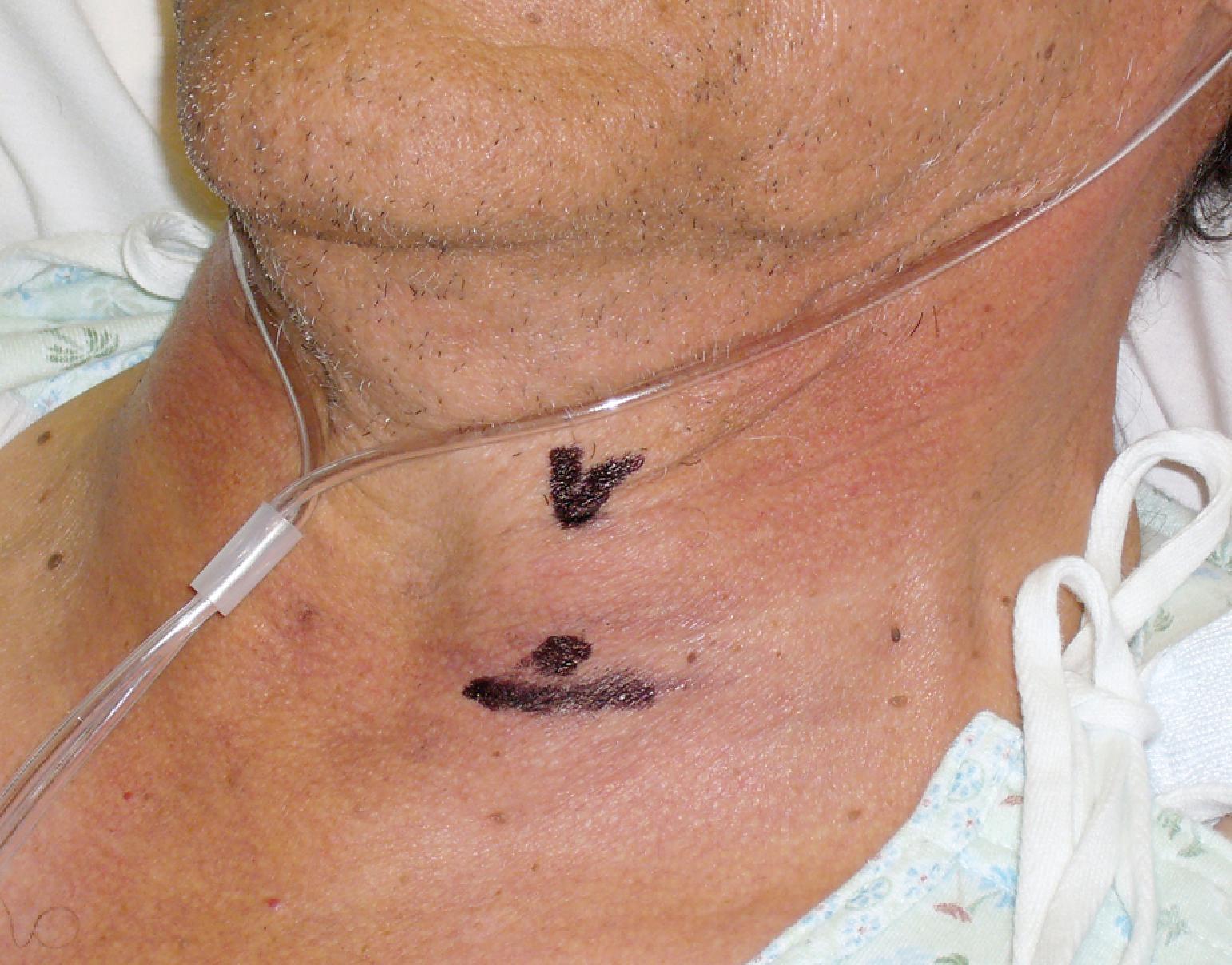 Fig. 38.7, A patient with a laryngeal carcinoma, fixed hemilarynx, and severe inspiratory stridor. The black check mark indicates a thyroid notch, the horizontal black line corresponds to the top of the cricoid cartilage, and the black dot represents the location of the cricothyroid membrane. Notice the inflammatory skin changes. The vocal cords were visible during preoperative nasal endoscopy.