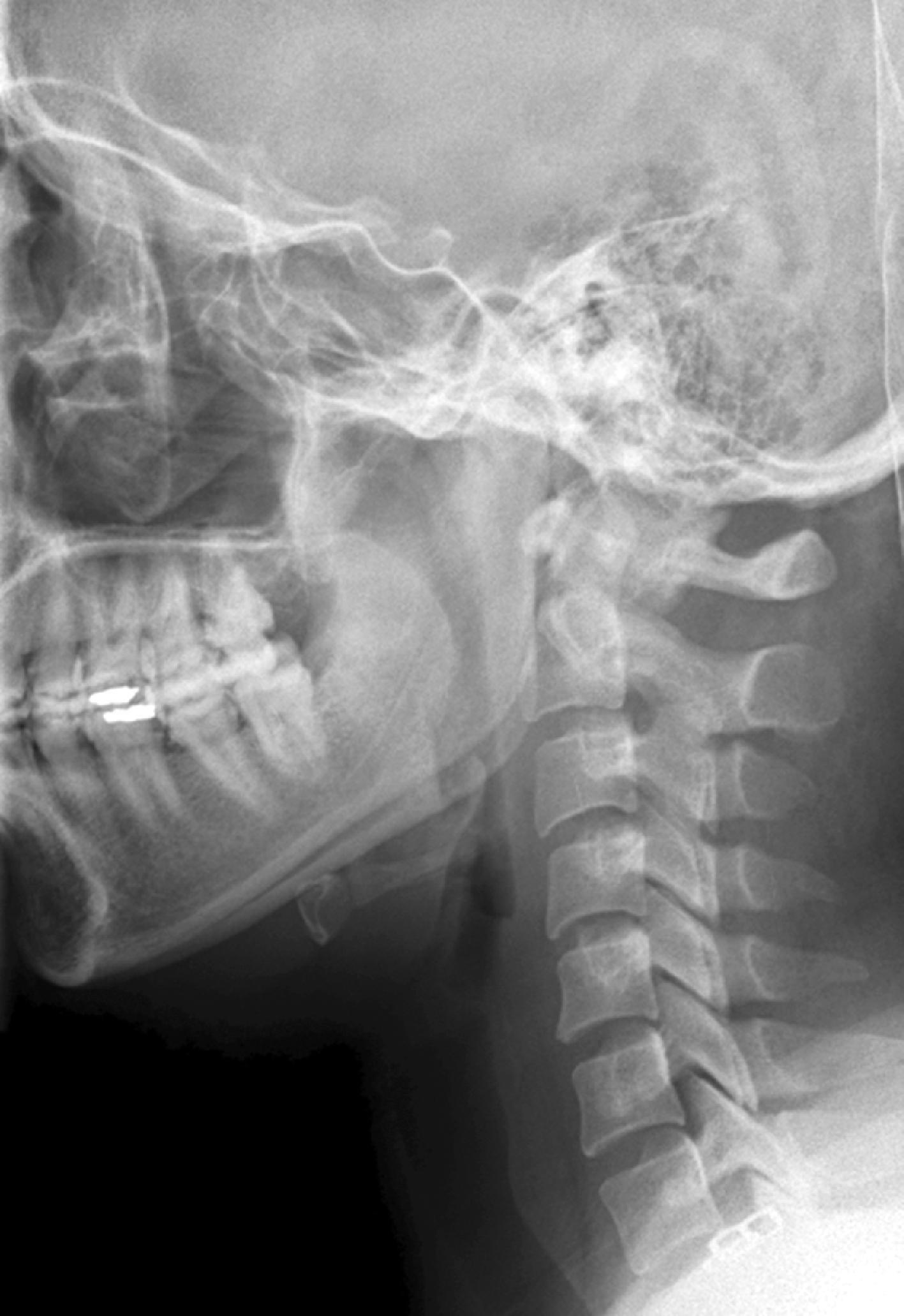 Fig. 39.1, Normal lateral cervical x-ray view.