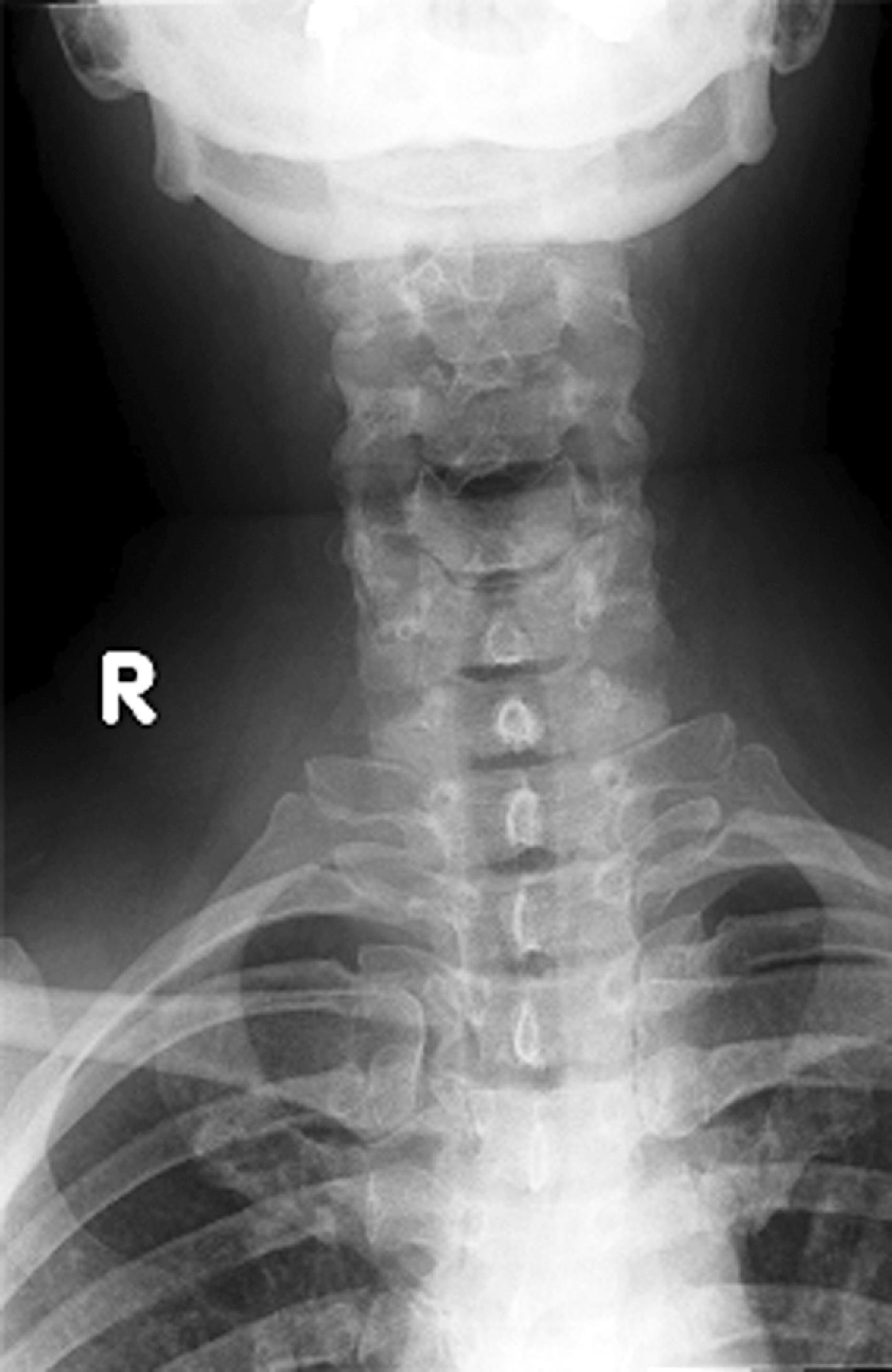 Fig. 39.2, Normal anteroposterior cervical spine x-ray view.