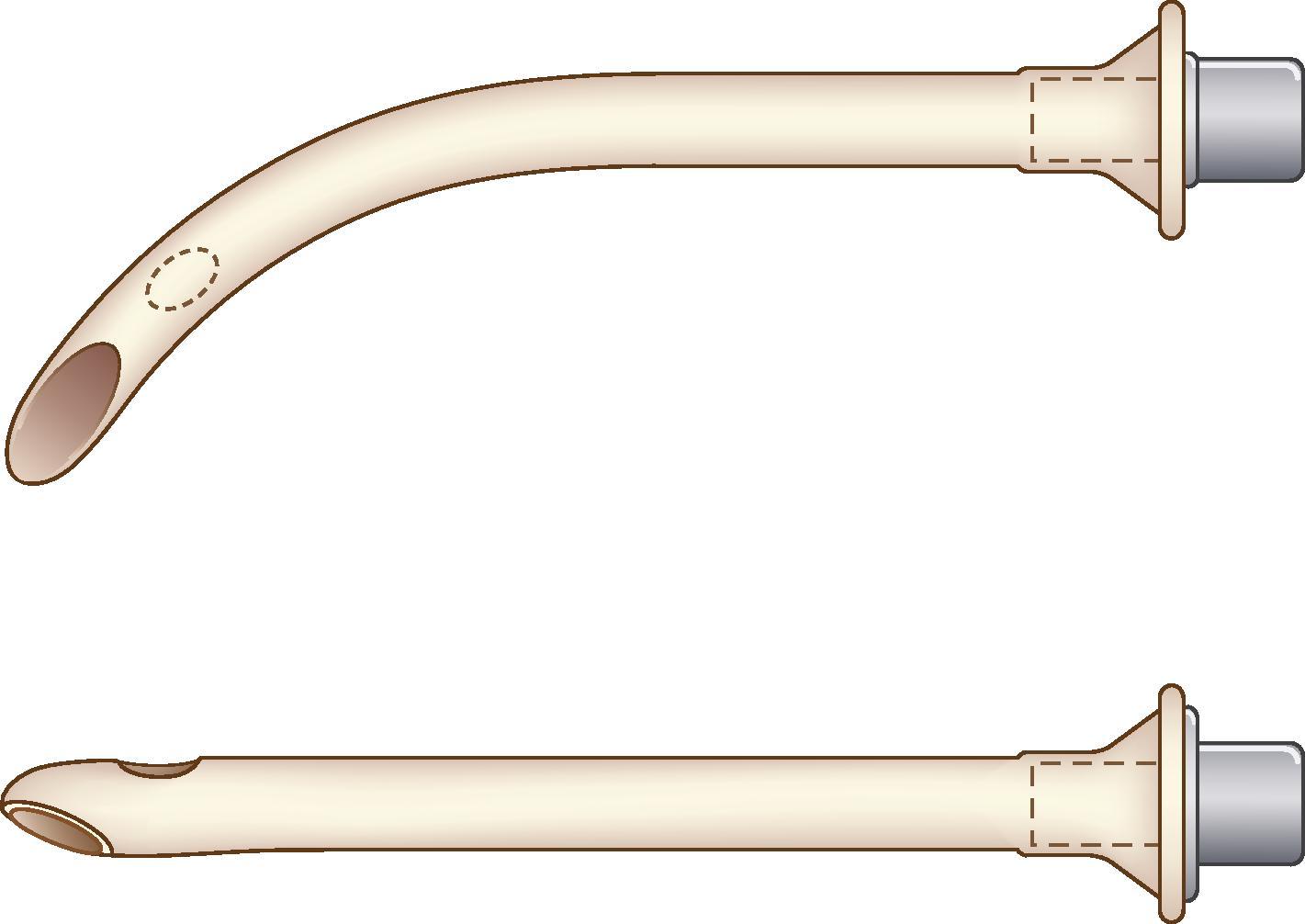 Fig. 36.4, Modified nasal trumpet airway by Beattie is a nasal airway with an endotracheal tube connector wedged into the flared end. The patient can be ventilated through this modified nasal trumpet. The mouth, lips, and the other naris should be closed.