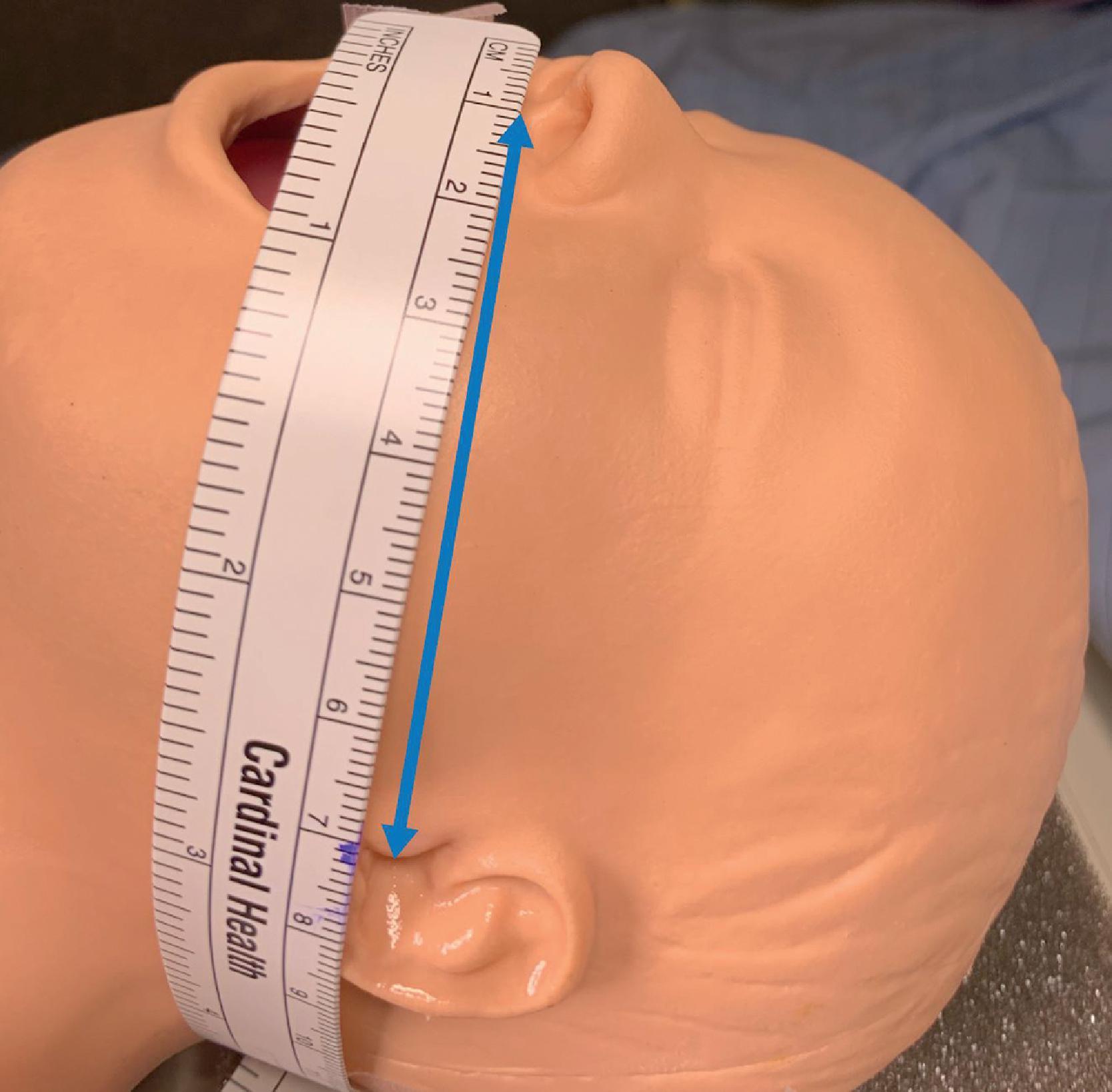 Fig. 36.5, Nasal-tragal length (NTL) can also be used to measure depth of insertion in neonates. A measurement is made from the center of the nasal septum to the tragus, and 1 cm is added to this number.