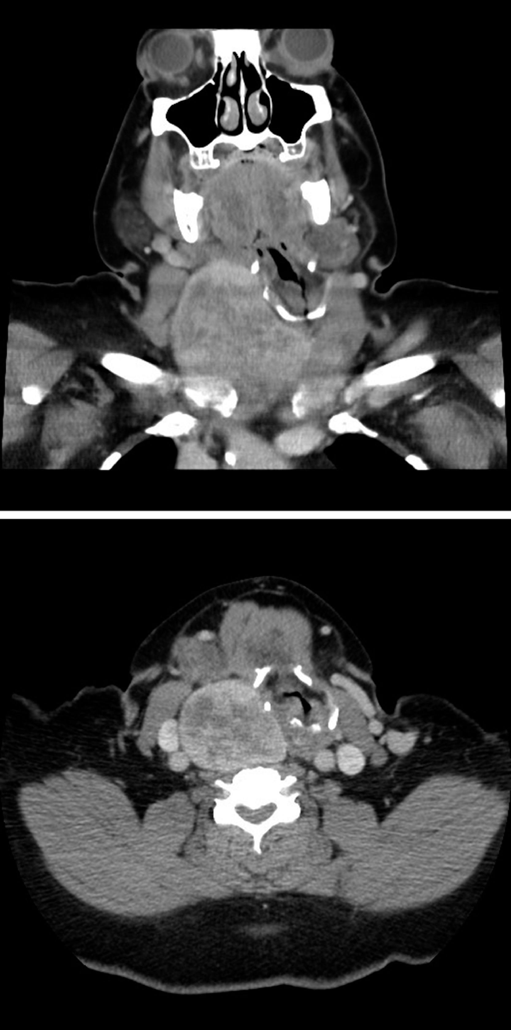 Fig. 17.1, Coronal (upper) and transverse (lower) planes of computed tomography (CT) images from a large thyroid mass. The CT images show significant left shift and compression of the larynx and trachea by the thyroid mass effect. However, the clinical evaluation indicated an asymptomatic patient with respect to respiratory status. The subsequent flexible scope intubation revealed insignificant airway compression suggesting a mismatch between CT findings and clinical presentation.
