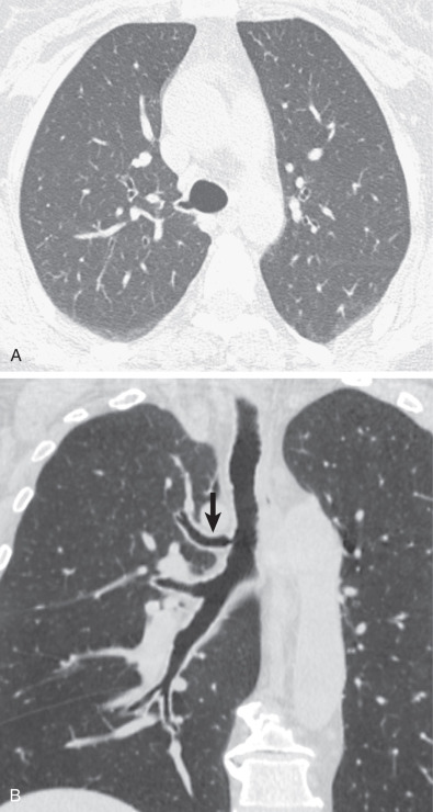 Fig. 7.1, Tracheal bronchus. CT (A) shows a small bronchus originating from the right tracheal wall. Coronal CT from a different patient (B) demonstrates the tracheal bronchus (arrow) supplying the apical segment of the right upper lobe.