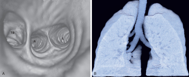 Fig. 7.2, CT bronchoscopy of a tracheal bronchus. (A) CT reformation with volume-rendering (“CT bronchoscopy” or “virtual bronchoscopy”) demonstrates a view of the tracheal and bronchial lumina that resembles the view seen at bronchoscopy. The image shows a tracheal bronchus (TB), right main (R) bronchus, and left main (L) bronchus as “seen” from the level of the lower part of the trachea. (B) A coronal three-dimensional external volume-rendering image shows a tracheal bronchus entering the right lung.