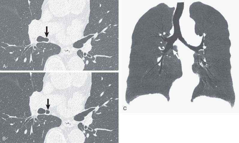 Fig. 7.3, Accessory cardiac bronchus. Axial CT (A and B) shows a cardiac bronchus (arrow) originating from the medial wall of the bronchus intermedius, coursing medially, to end in a blind pouch similar to a diverticulum. A minimum-intensity projection coronal reformatted CT (C) of the central airways shows a medial and inferior course of the cardiac bronchus (arrow).